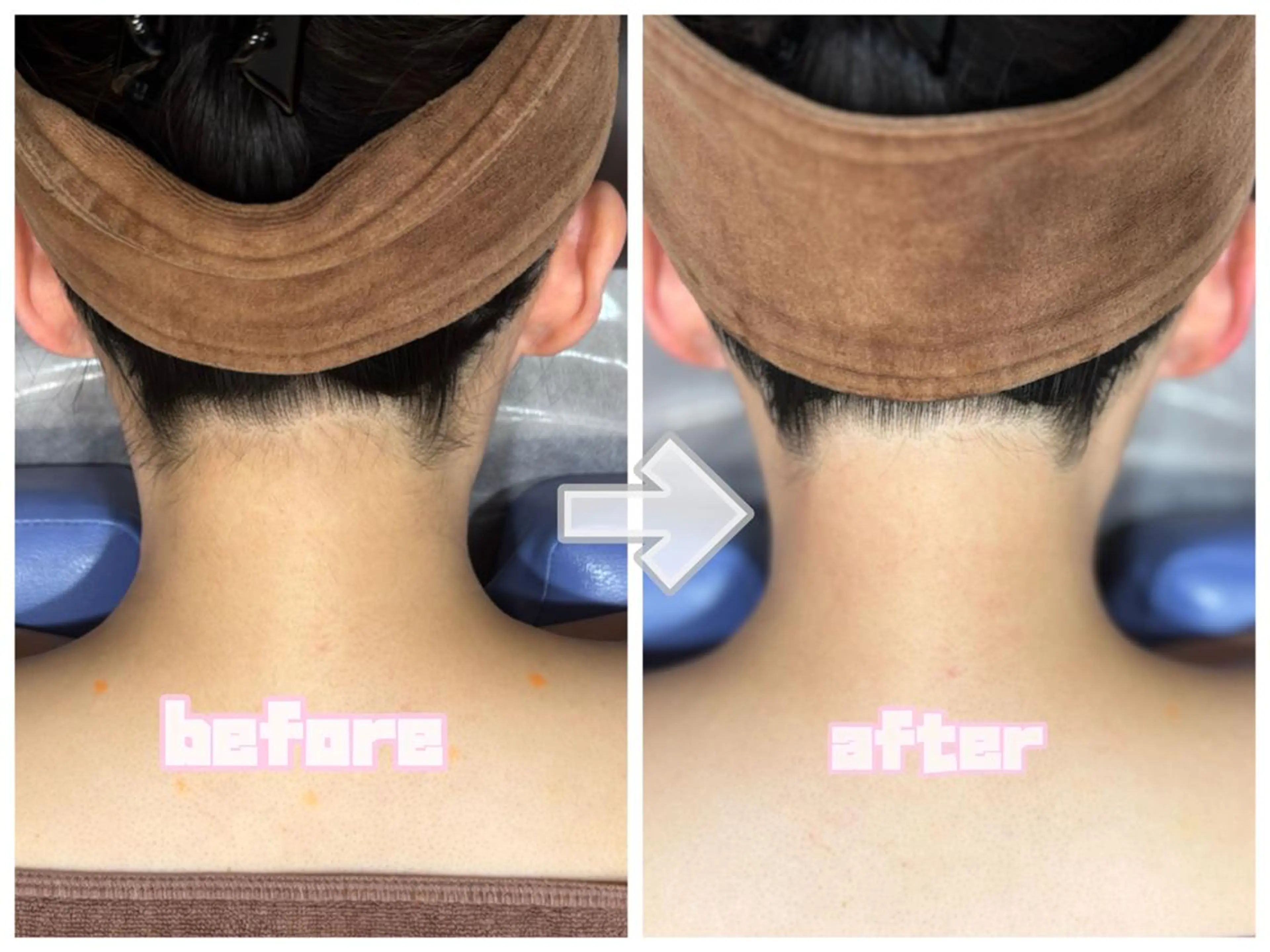 2026年成人式前うなじ脱毛👘🎍脱毛未経験の方大歓迎🥳着物を着るなら襟足の脱毛は必須です✨の写真