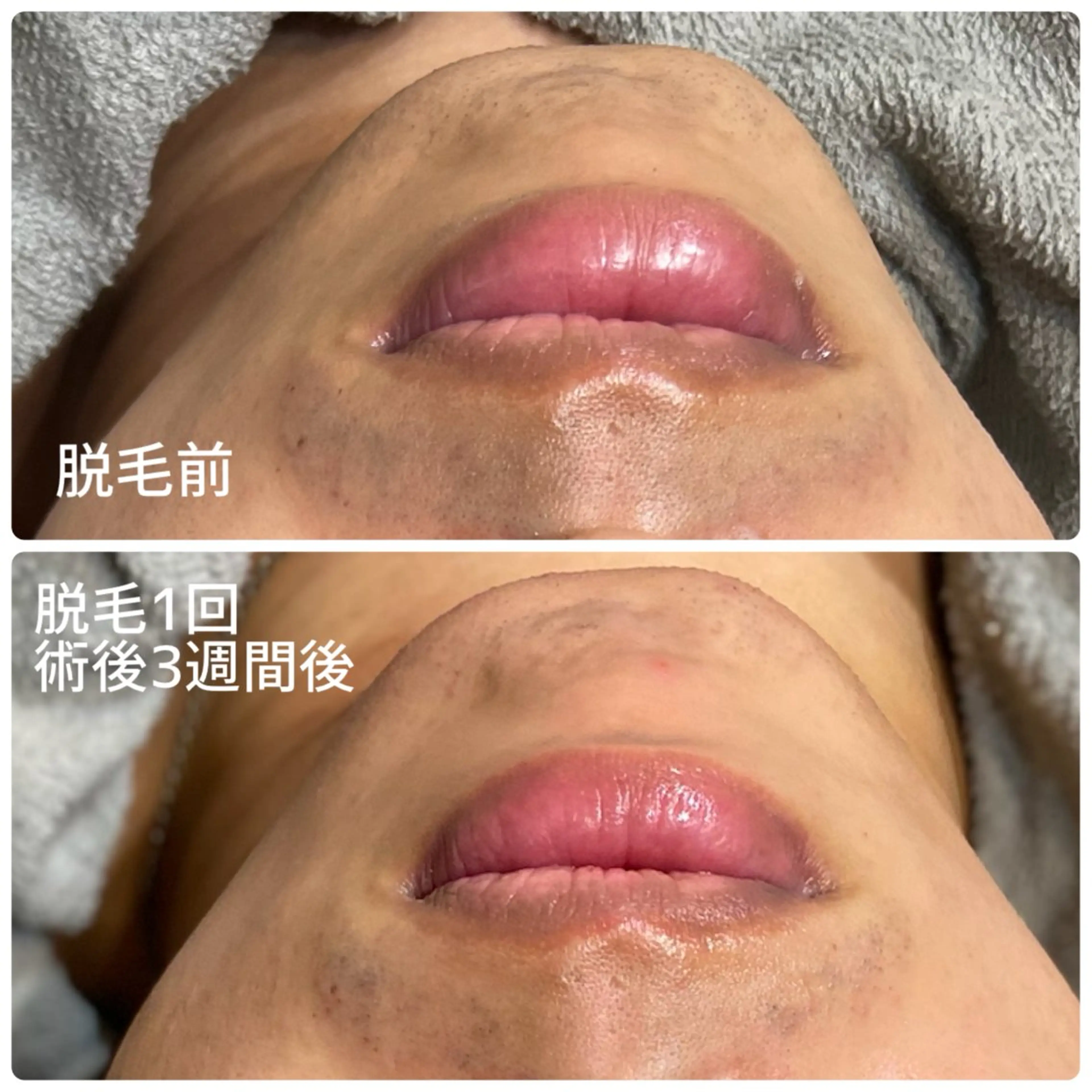 脱毛 LAESSE 恵比寿所属・ラエッセ 恵比寿 ⭐︎yuuka⭐︎のエステ・リラクイメージ