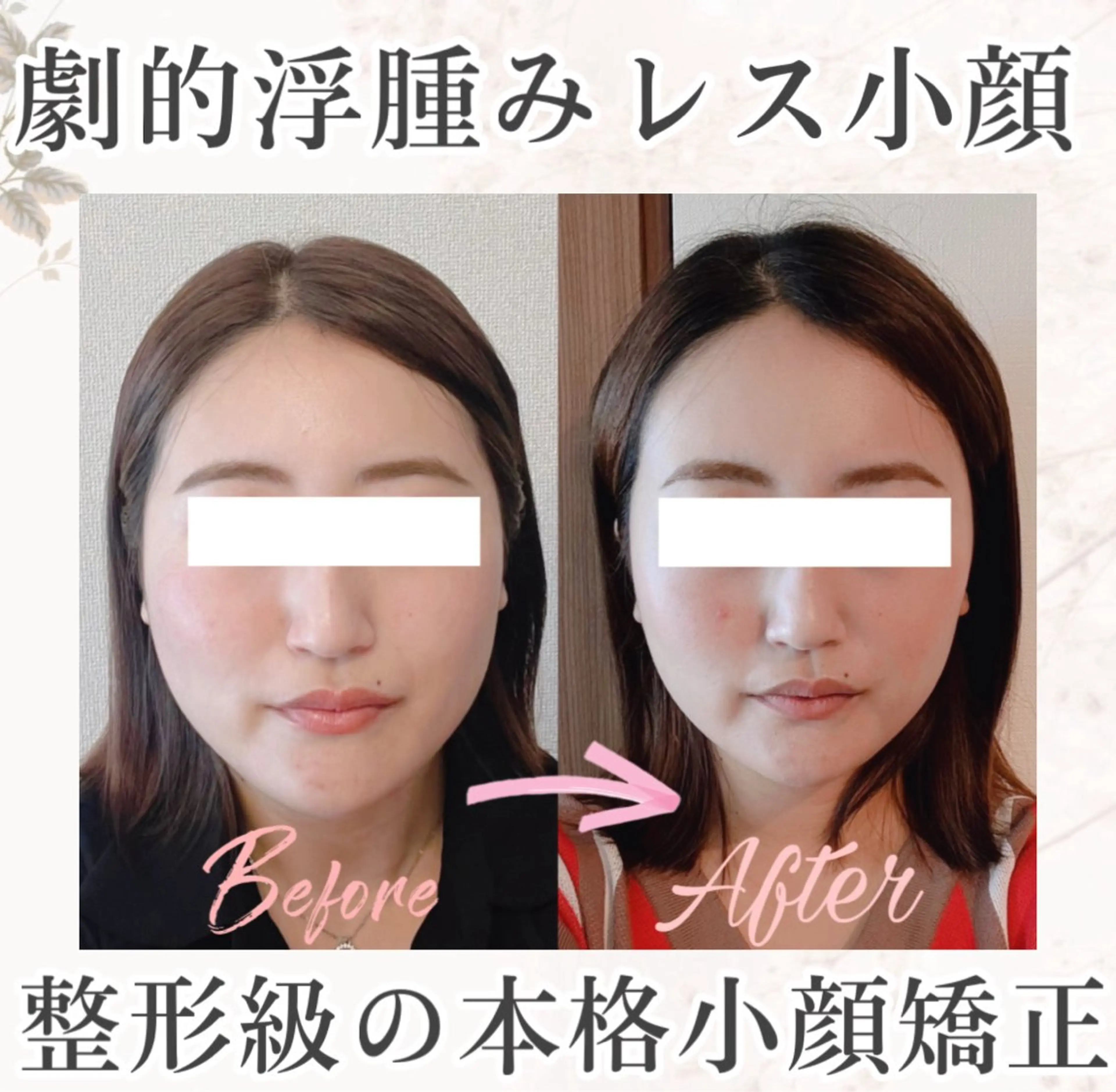 30代限定❤️‍🔥韓国女優級小顔✨たるみ・むくみ徹底撃退🔥本格小顔矯正の写真