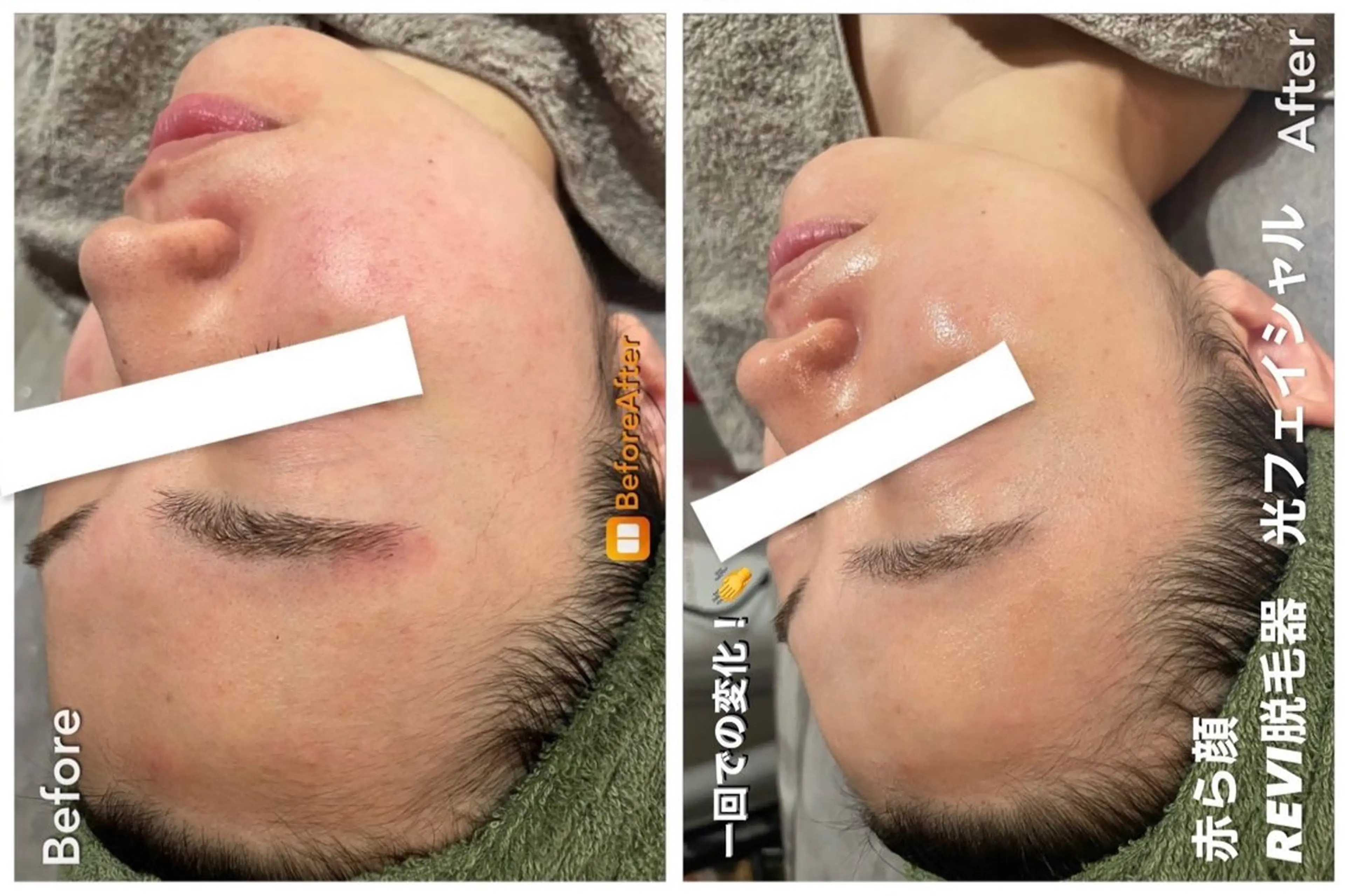 エステ Meupニキビ専門店 背中/ハーブ/ララのその他イメージ