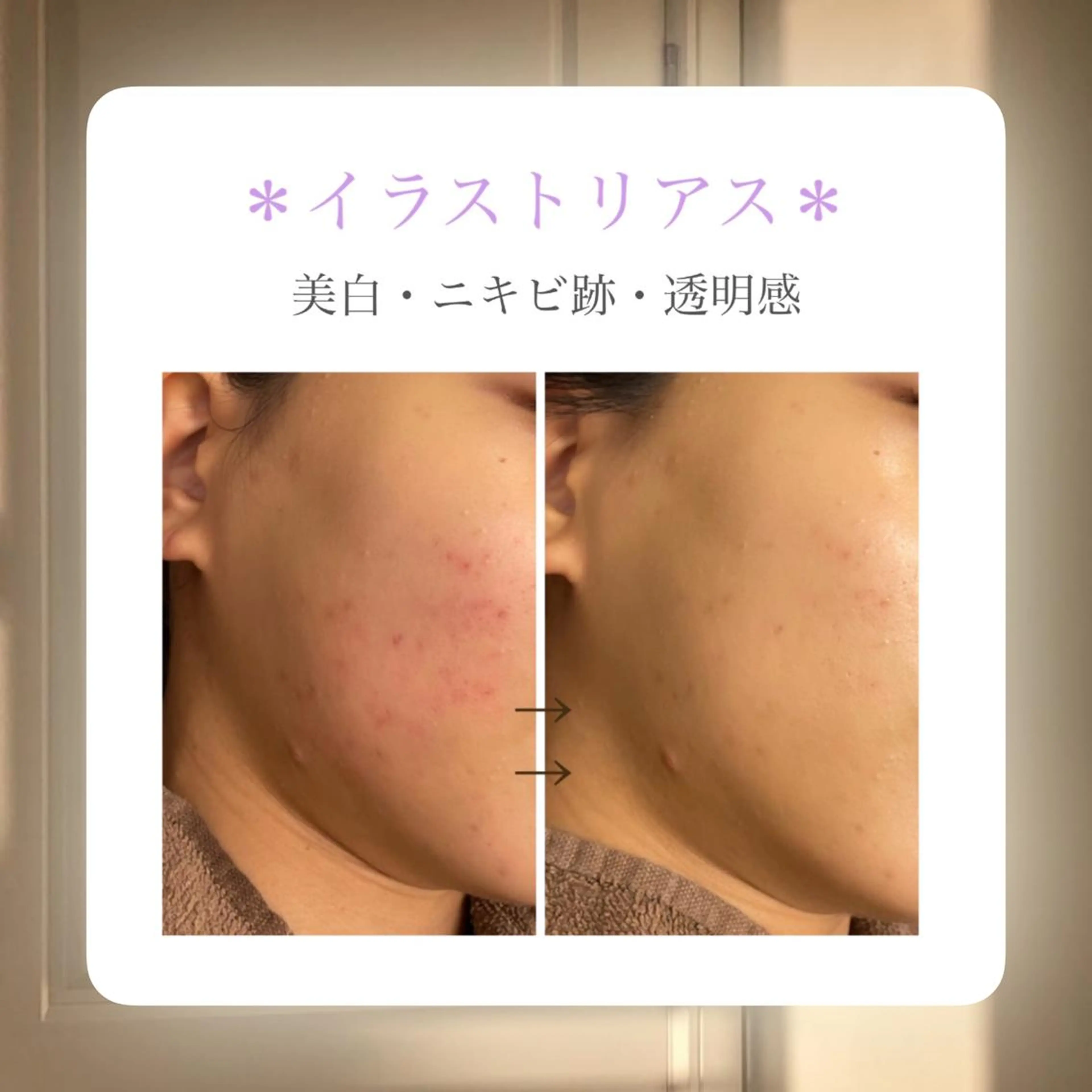 美白を手にれたい方🙋‍♀️💕シミ・ニキビ跡・色素沈着・くすみ改善💕クリスティーナ【イラストリアス】✨の写真