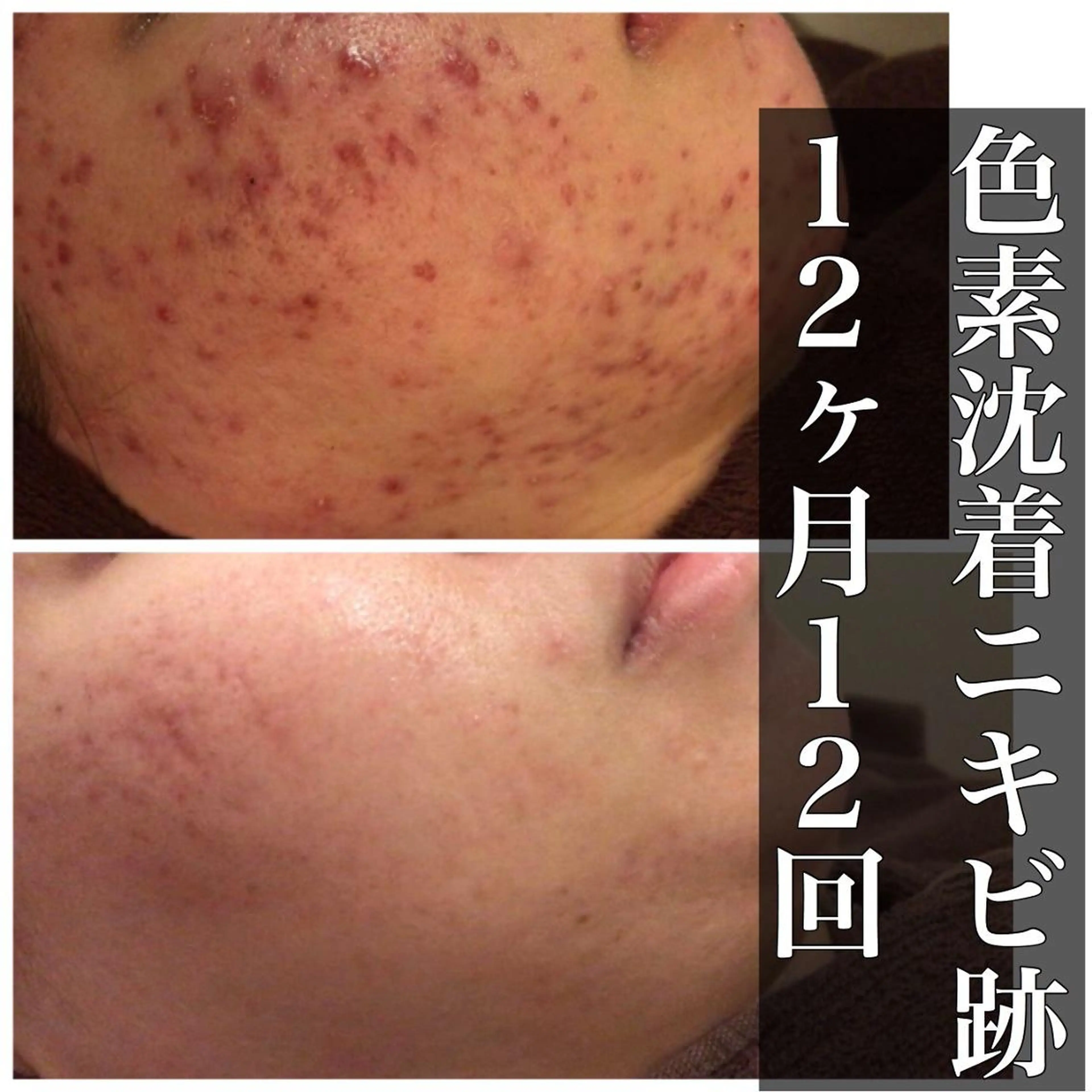 皮膚科より効果あり ⁉️最短ニキビ改善のエステ・リラクイメージ