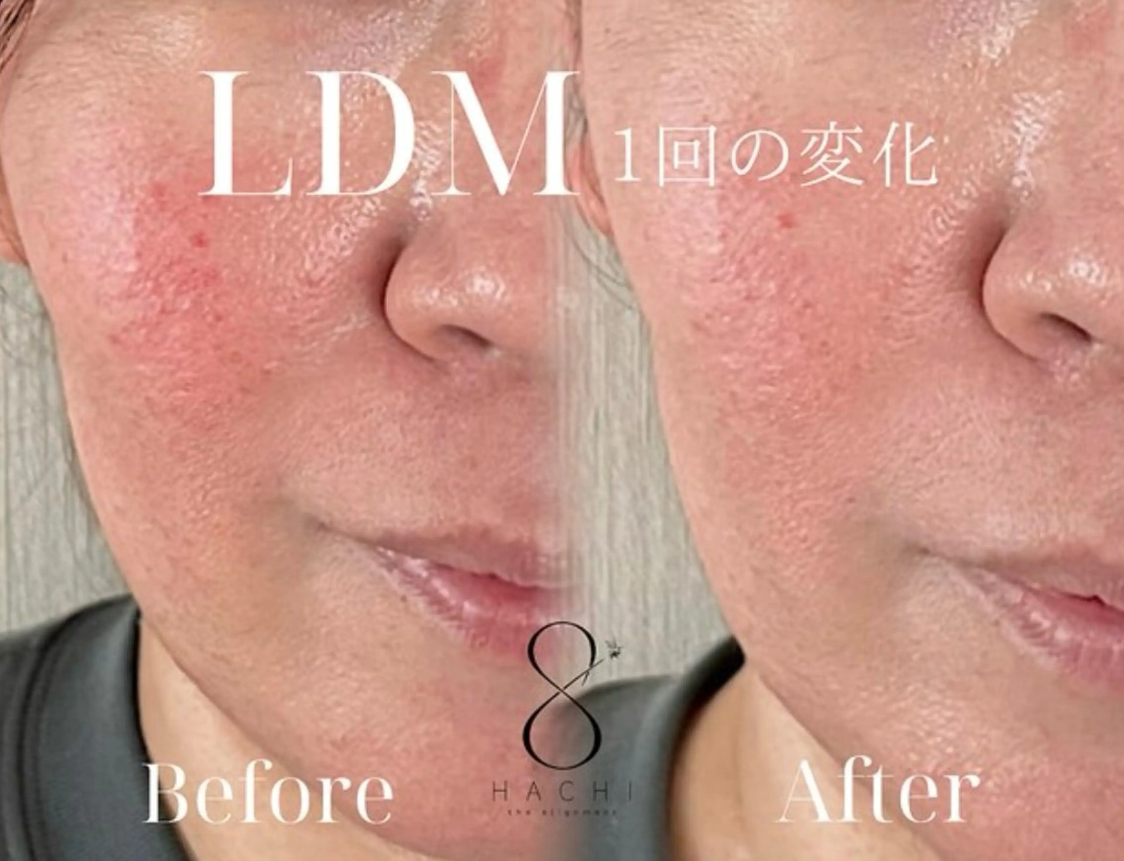 【9月末まで】大人気！水玉リフトLDMツヤ肌コース／エレポ冷却導入付きの写真