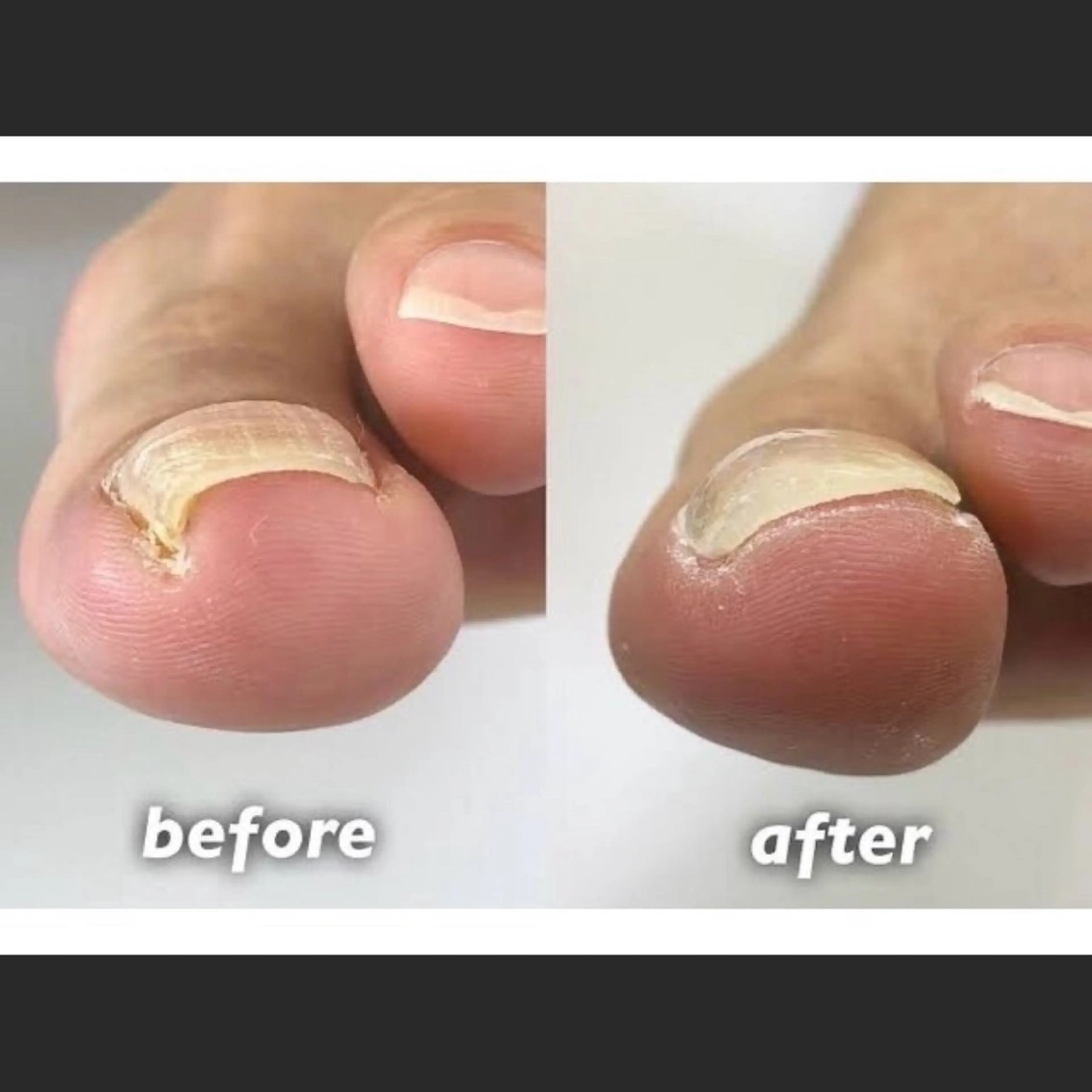 foot巻き爪矯正 👣✨　初回❕の写真