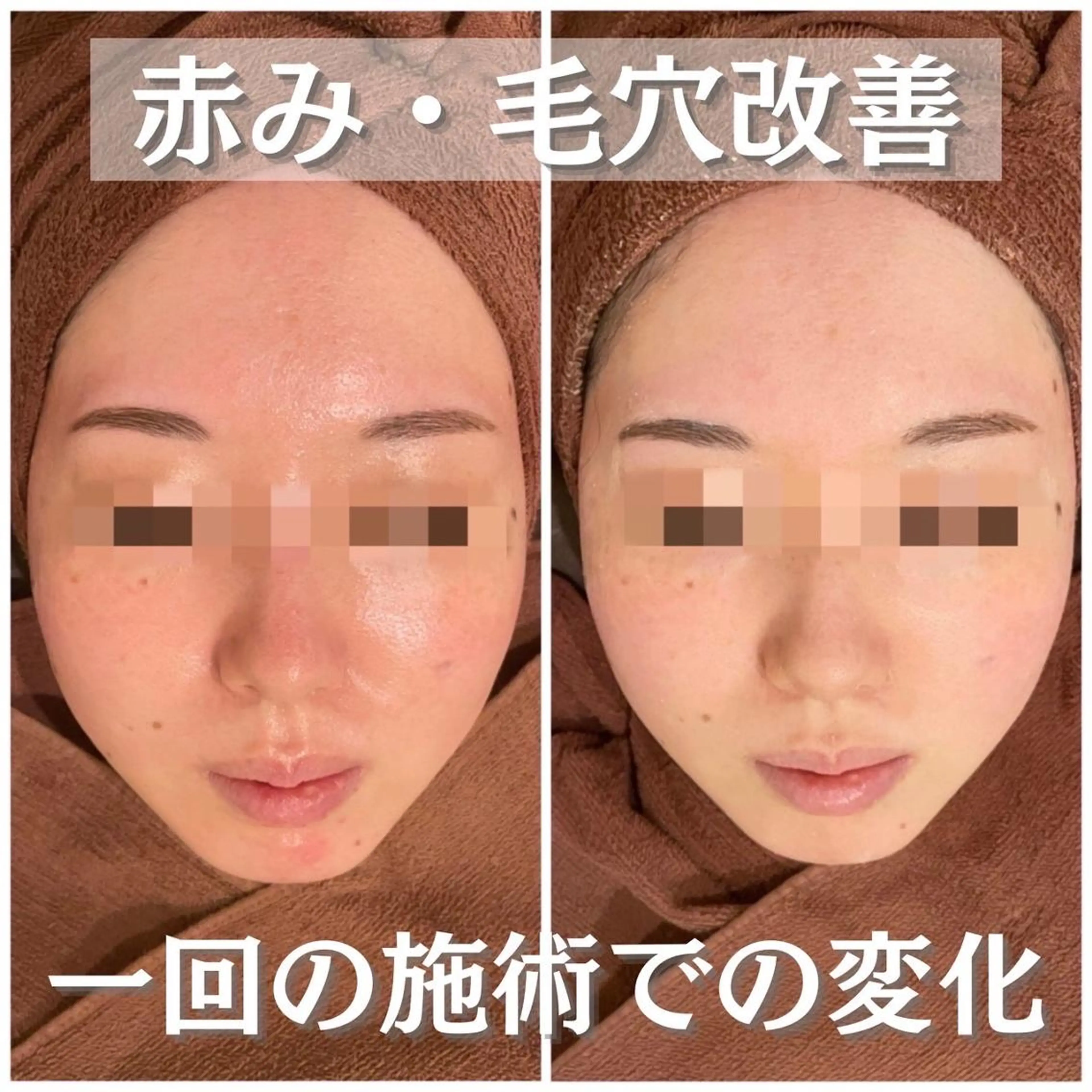 🔥3か月で肌革命 🔥ニキビ専門店のエステ・リラクイメージ