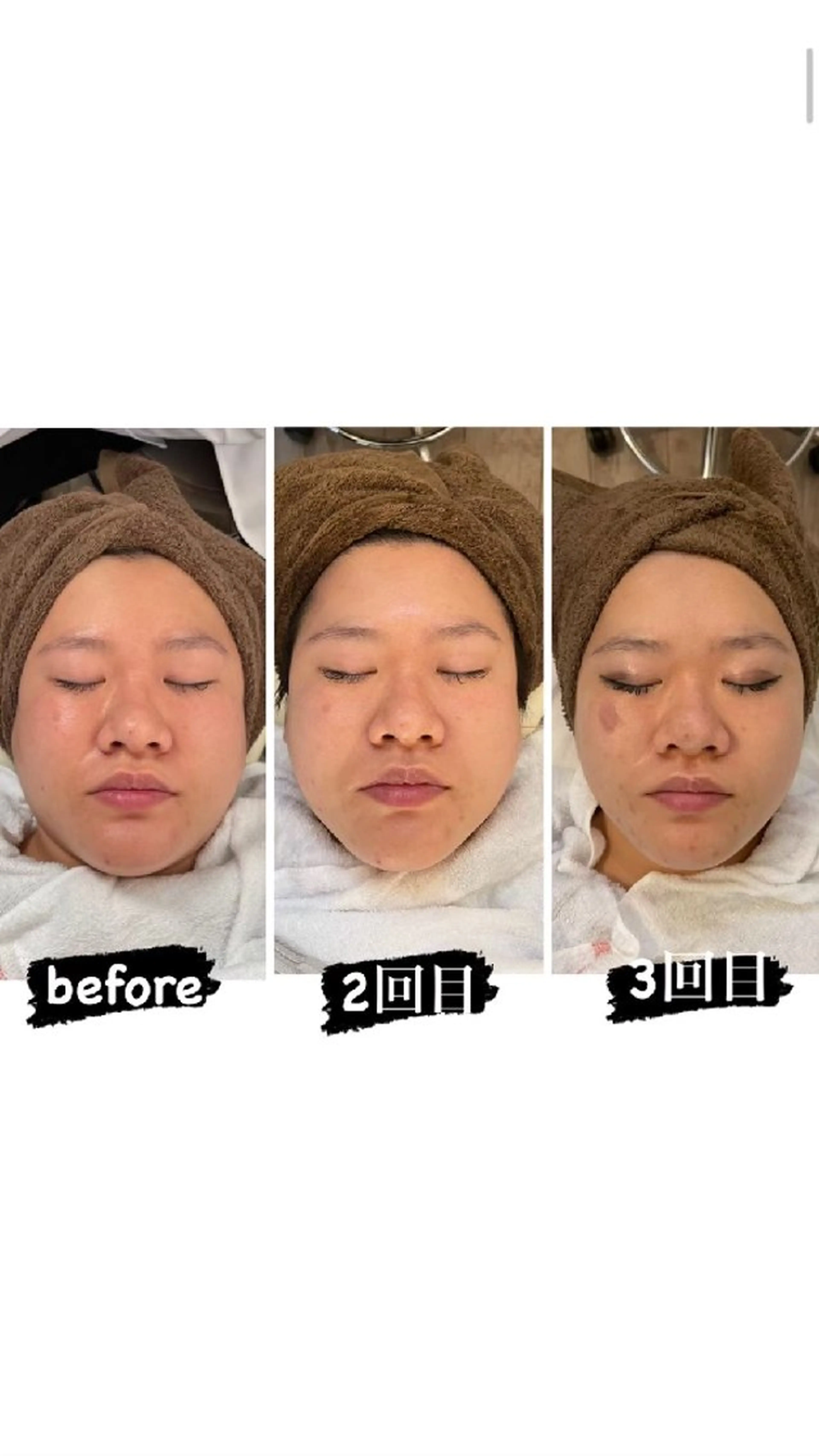 【最強小顔セット】効果抜群！！切らずにお肉撃退十小顔リフトの写真