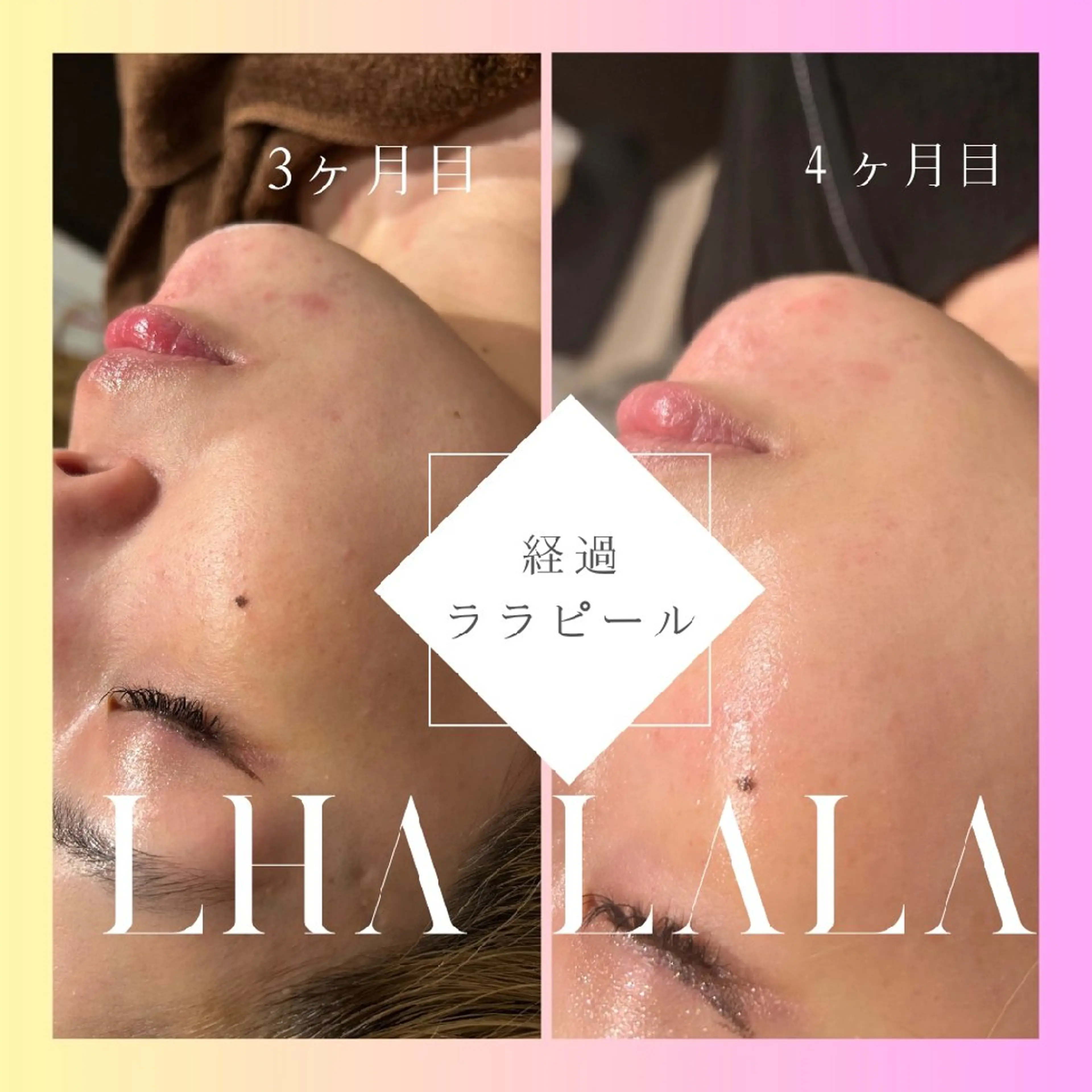 MAHANA 耳ツボ/毛穴洗浄のエステ・リラクイメージ