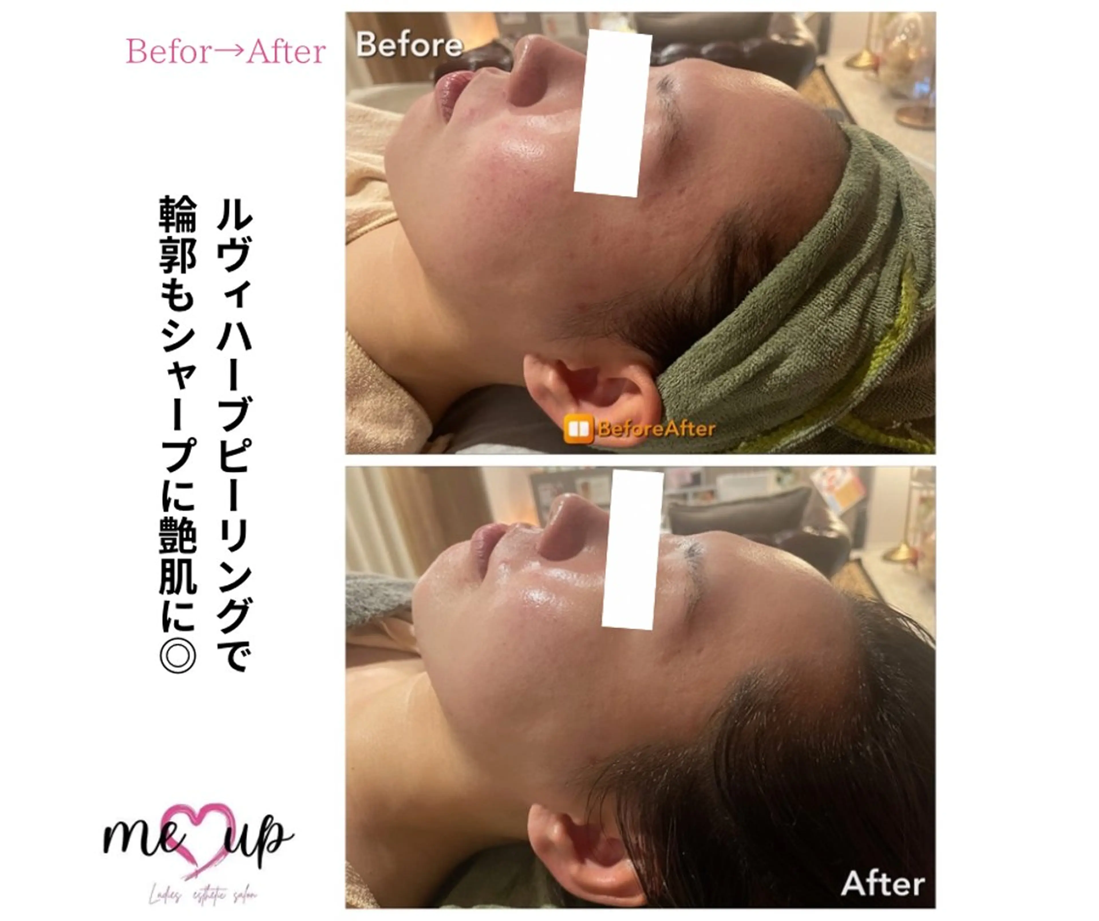 エステ Meupニキビ専門店 背中/ハーブ/ララのその他イメージ