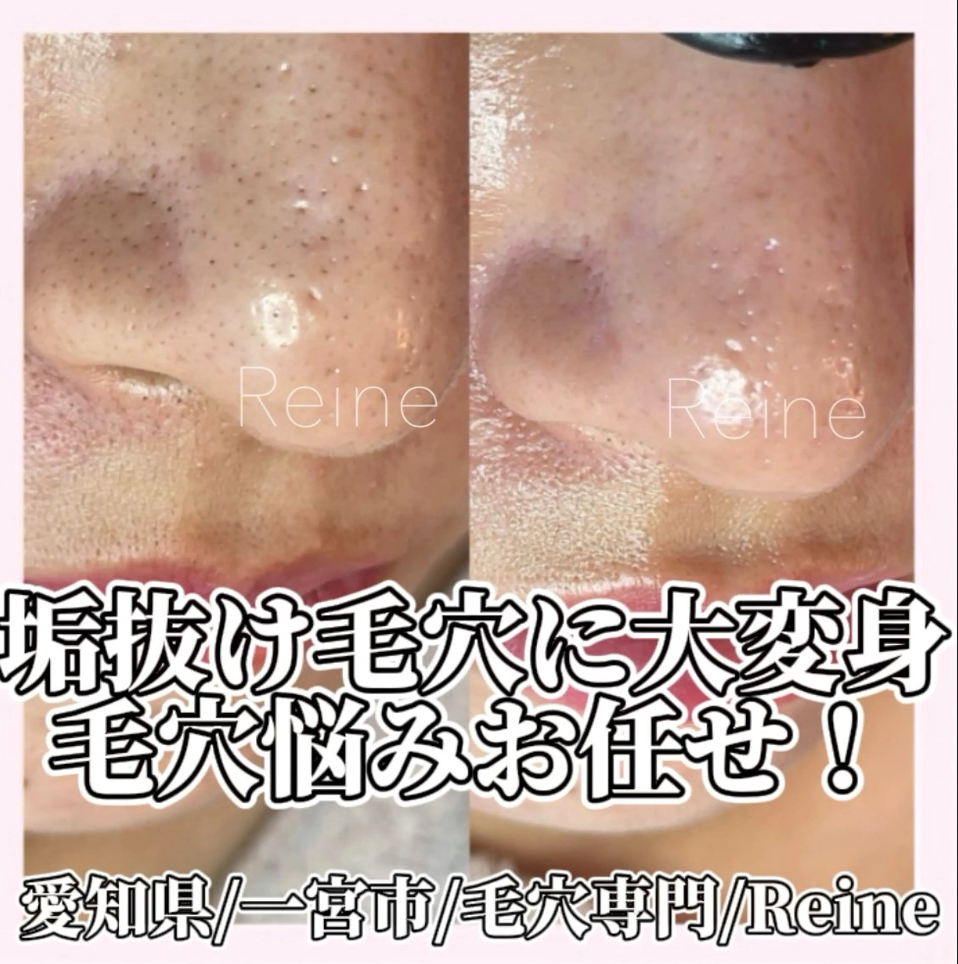 エステ Reine BeautySalon所属・毛穴/シミ肝斑/脱毛 横山梨里のエステ・リラクイメージ