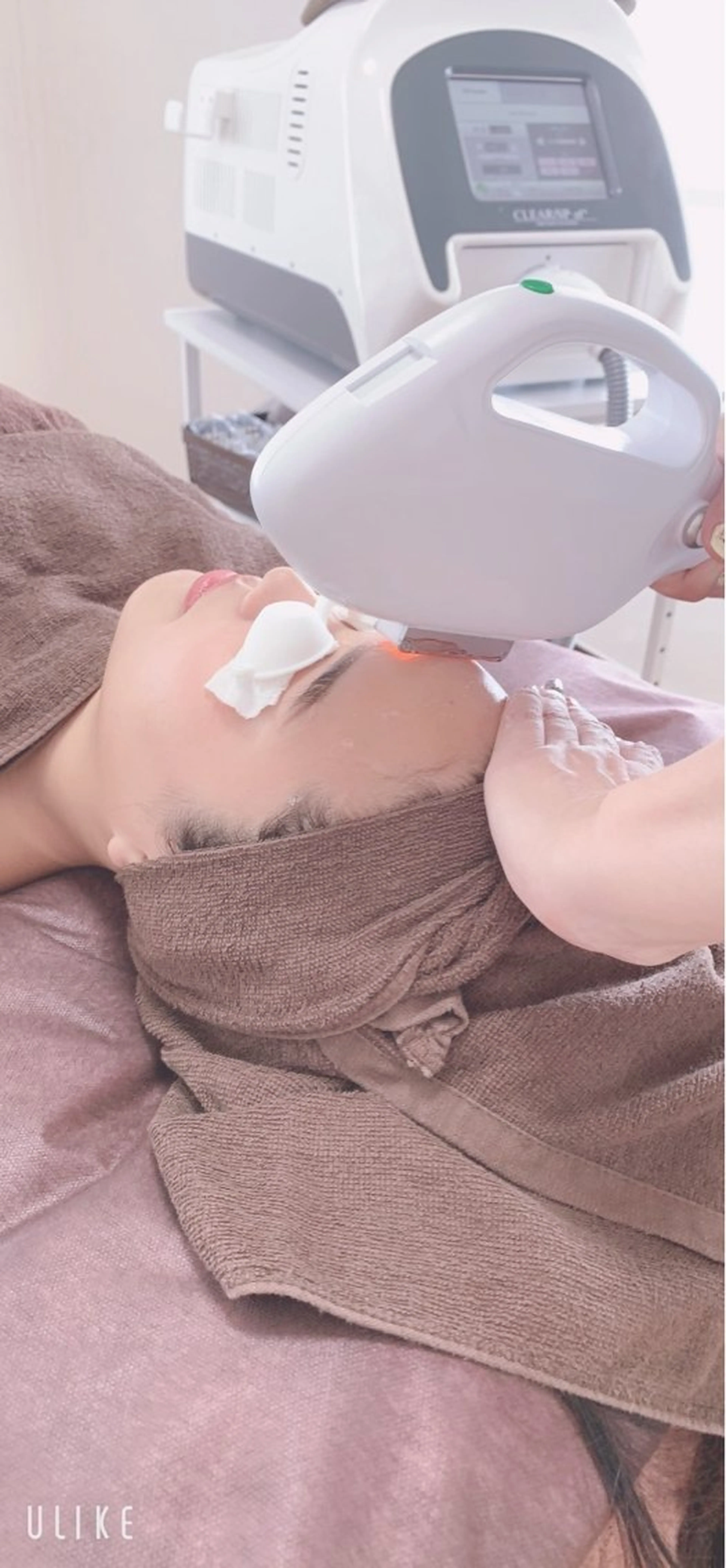 【ミニモ限定特典付】おでこ脱毛の写真