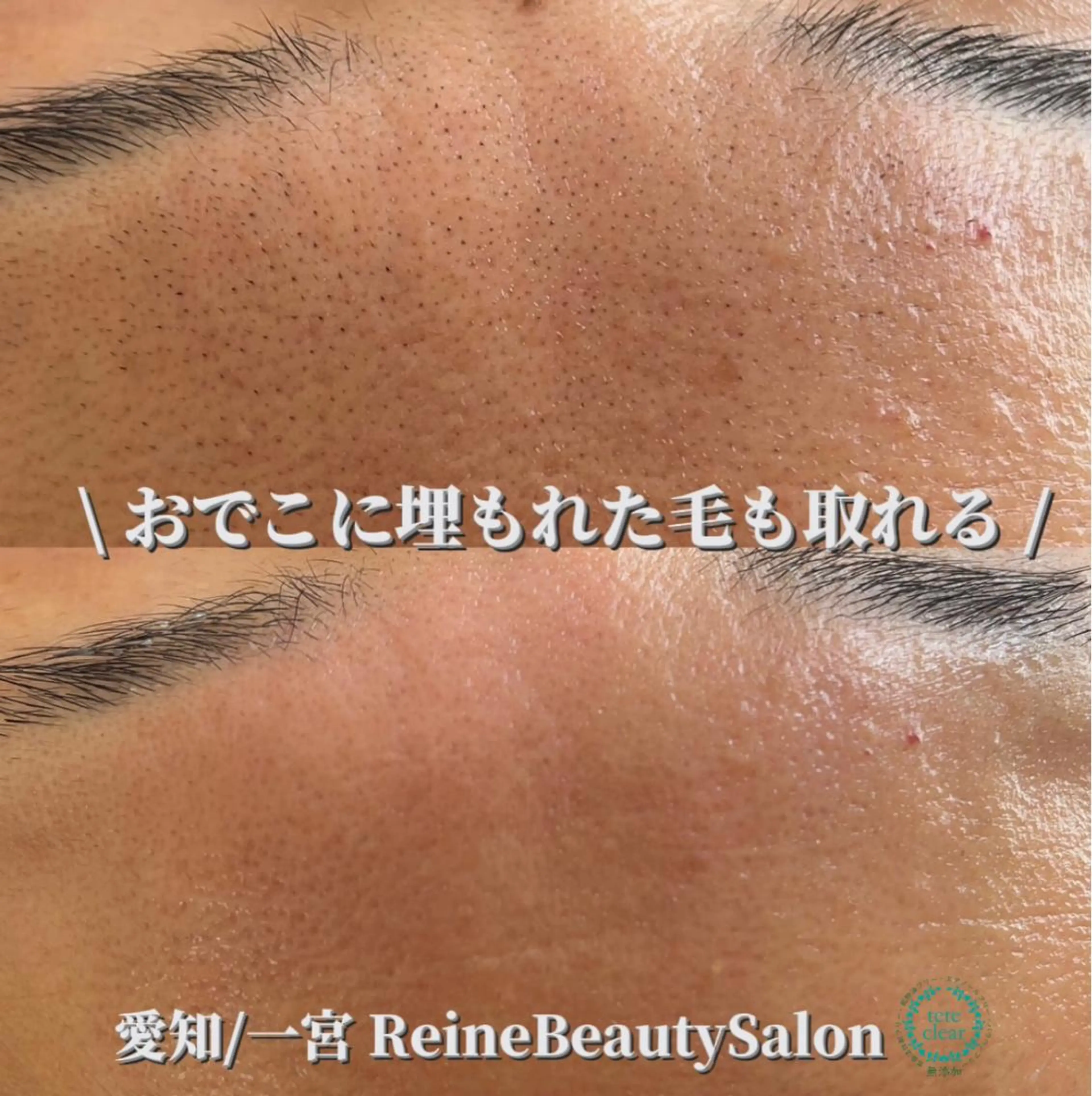 エステ Reine BeautySalon所属・毛穴/シミ肝斑/脱毛 横山梨里のエステ・リラクイメージ