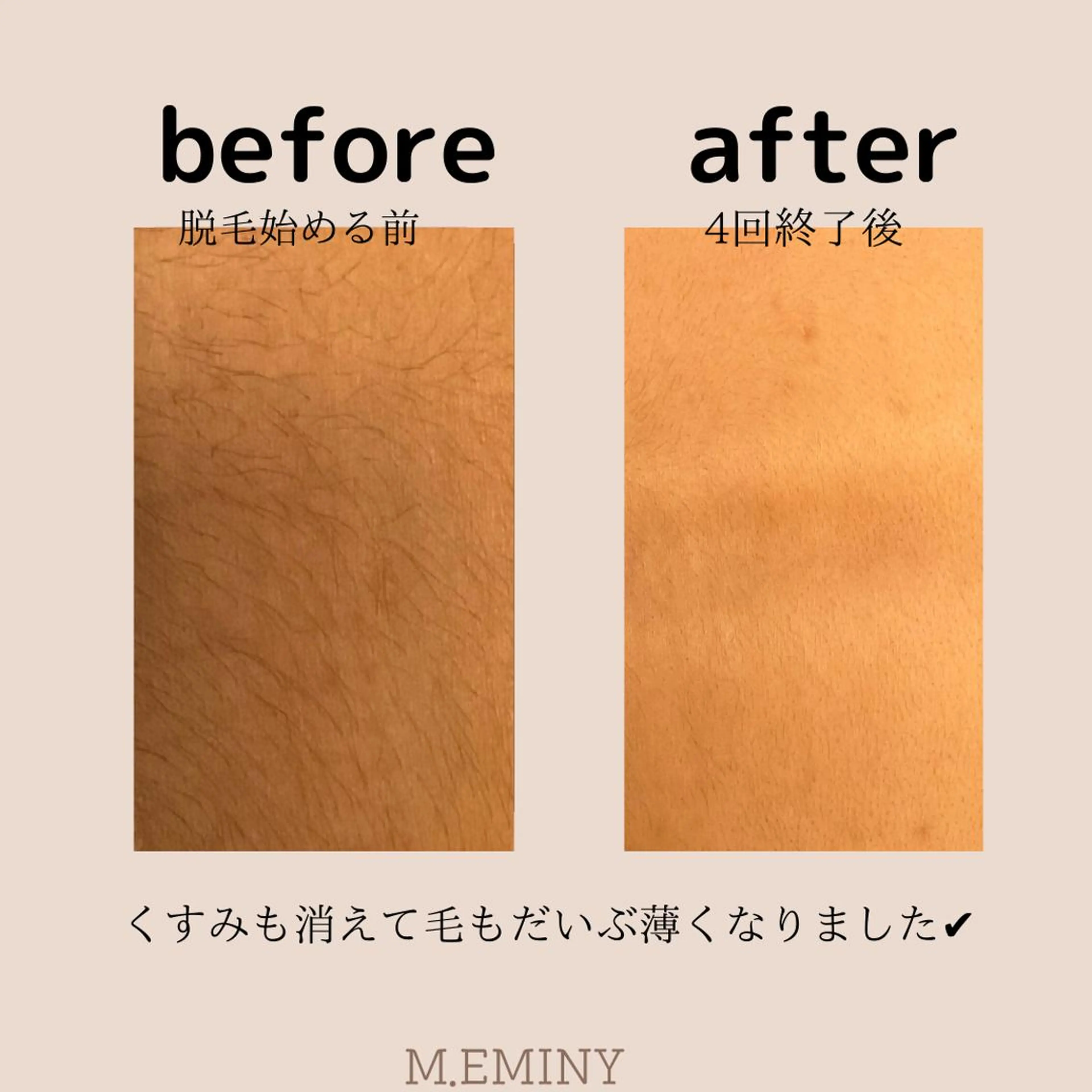 脱毛 &relaxation　M.EMINY所属・大分賀来リラクサロン M.EMINYのエステ・リラクイメージ
