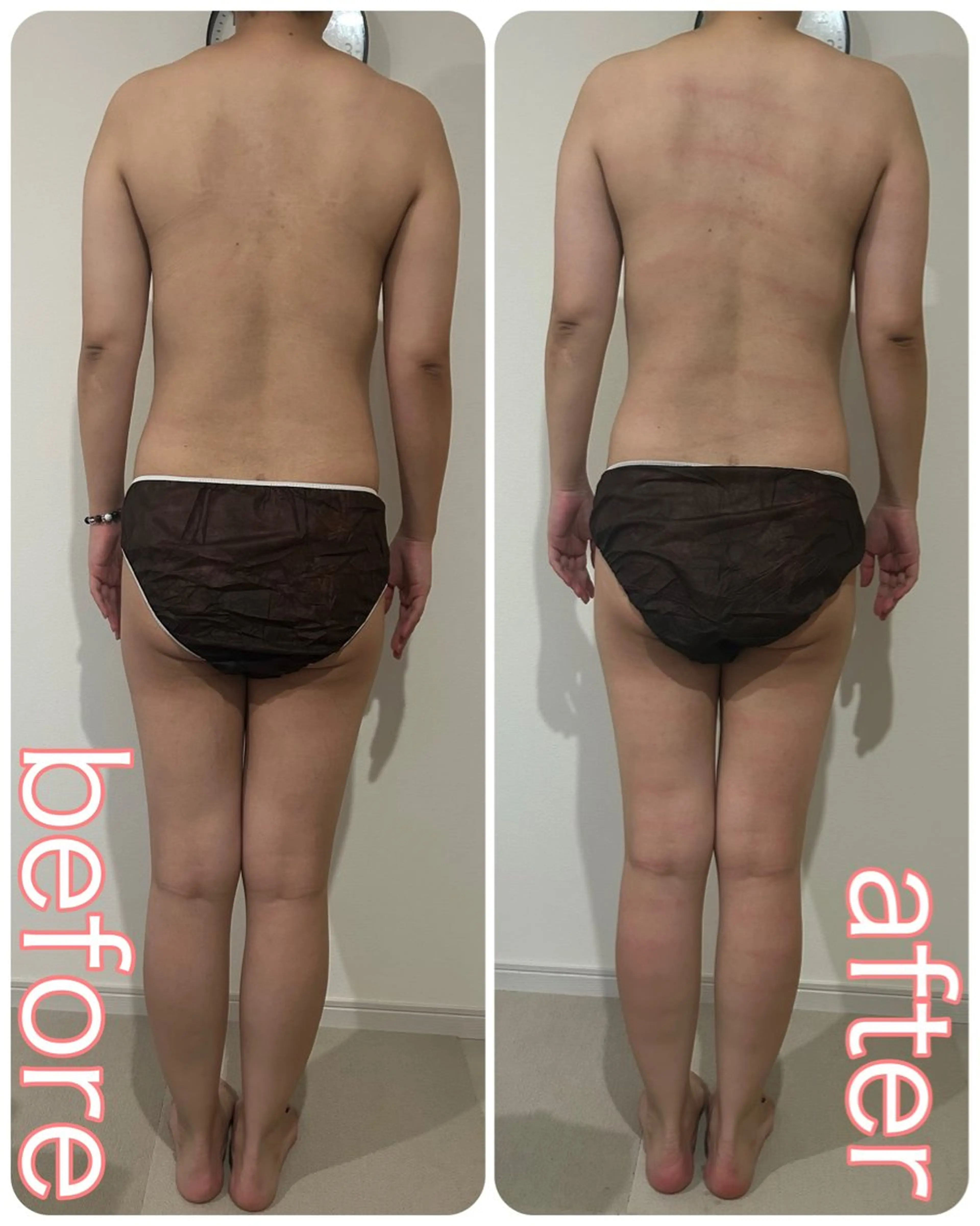 リンパクレンズ®️5回コースの写真