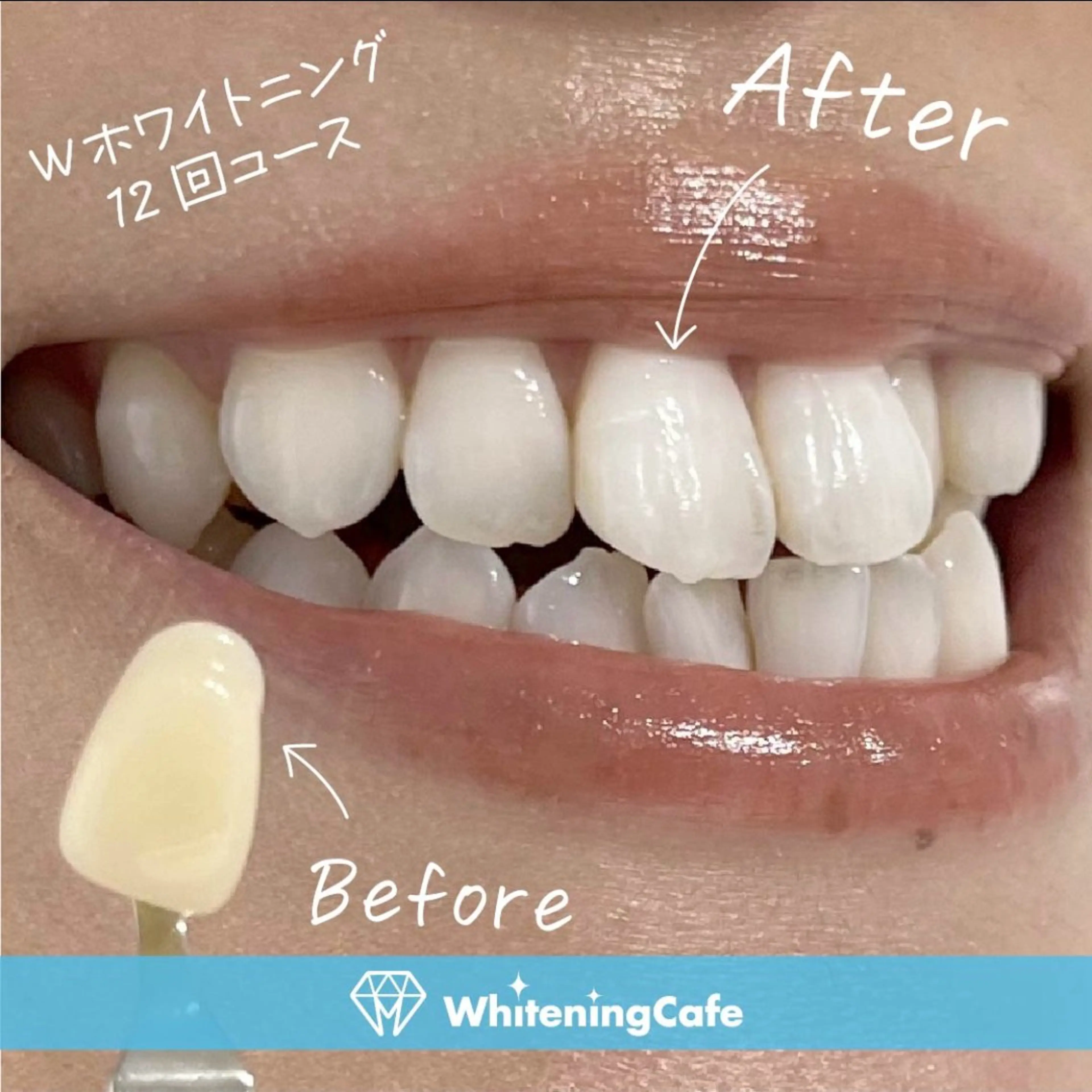 【1番お得/セルフホワイトニング回数券】12回コース+セルフホワイトニング1回プレゼント！の写真