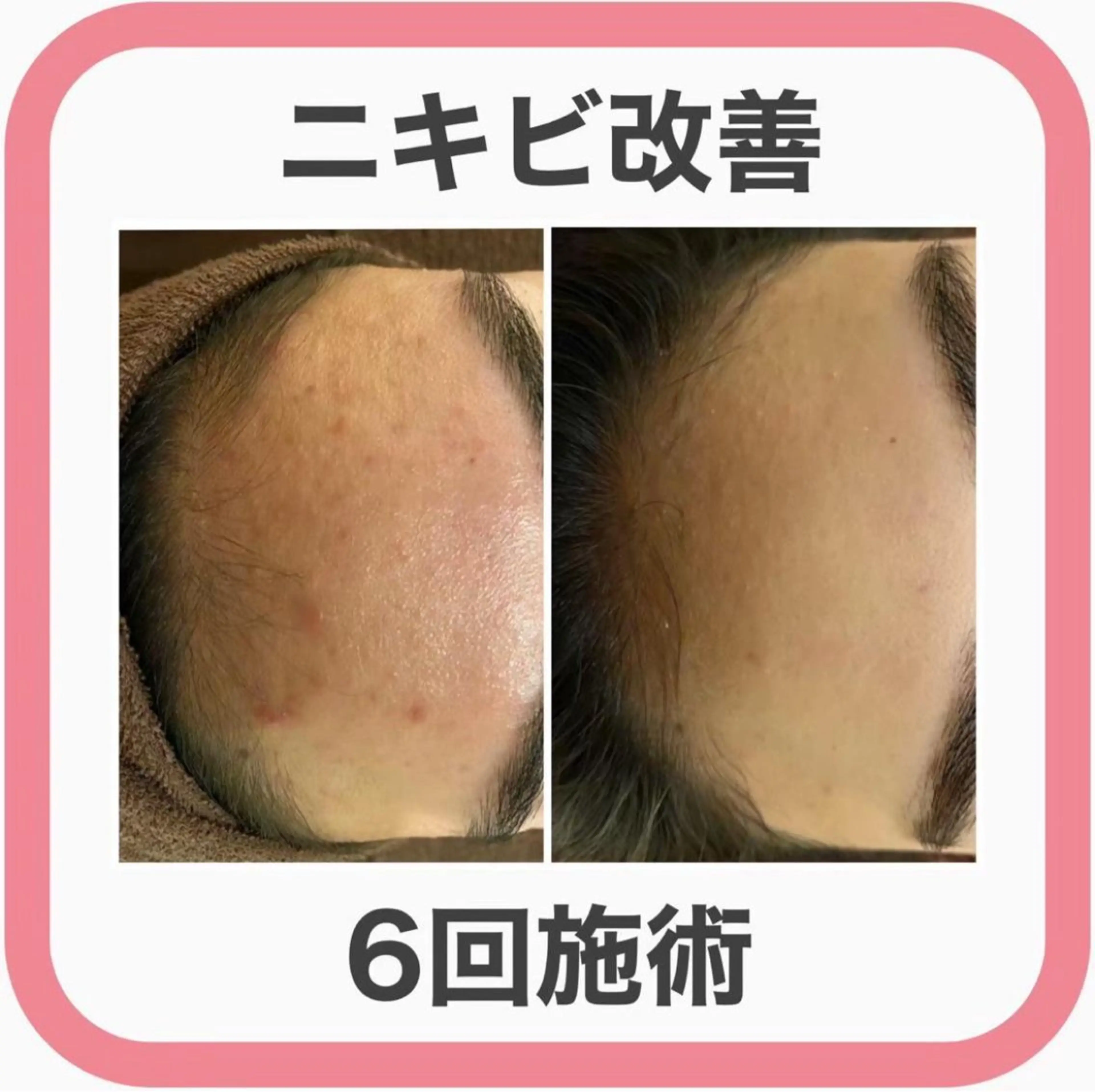 学生ニキビ改善🍀 優しい肌質改善のエステ・リラクイメージ