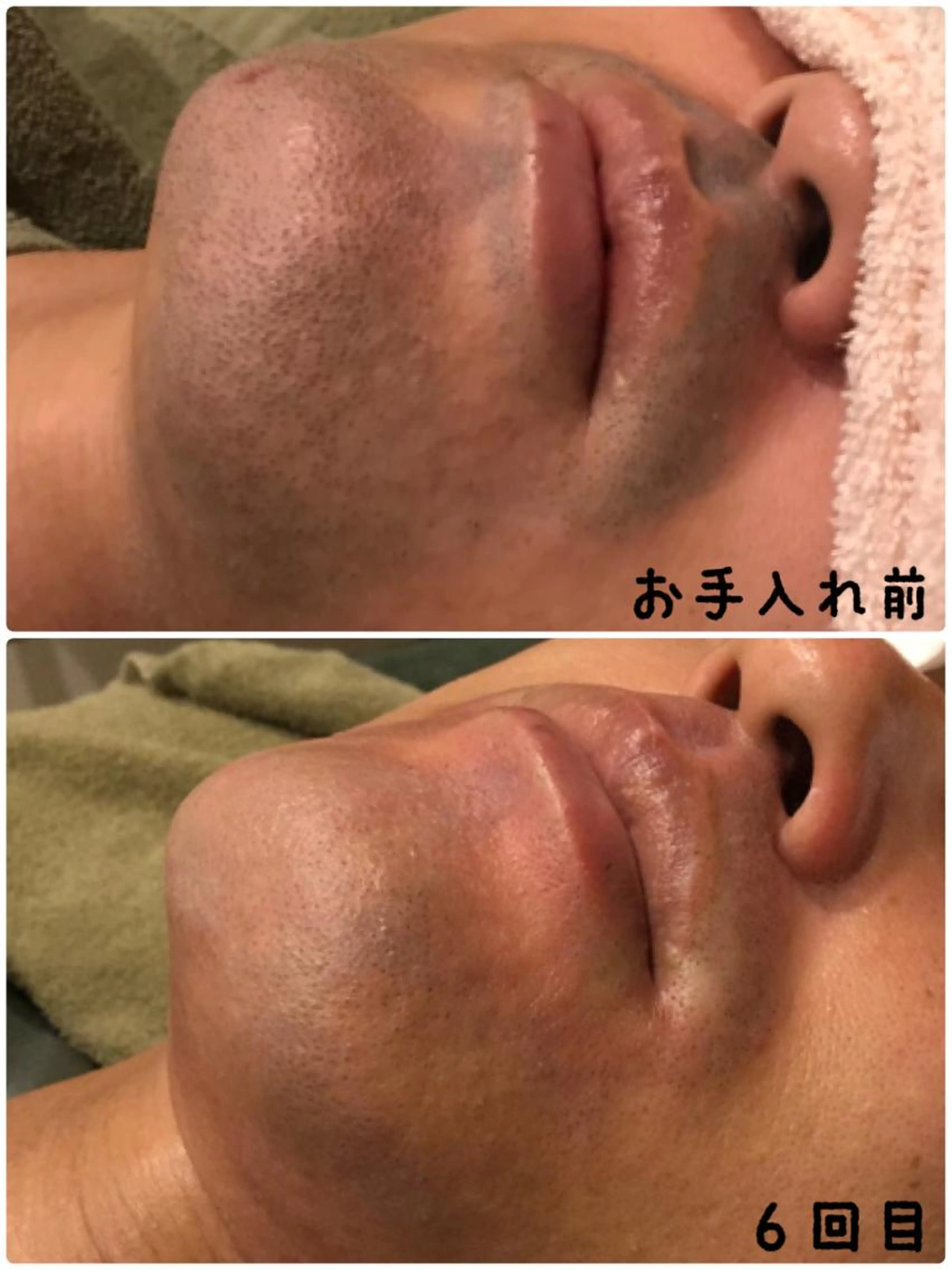 ≪新規≫Men’sヒゲ脱毛 回数：1回の写真