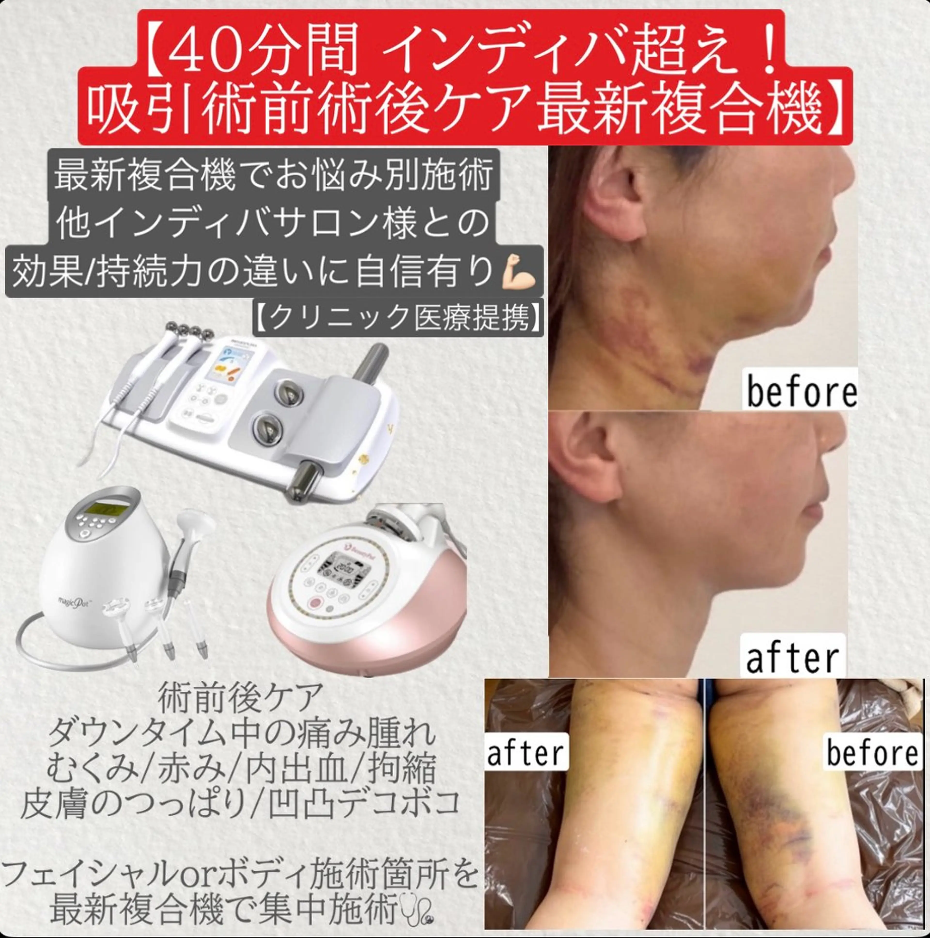 医療提携🩺人気No.3🥉脂肪吸引術前術後ケア🥼最新複合痩身機でインディバ超えの効果に自信アリ💪🏻40分徹底ケアの写真
