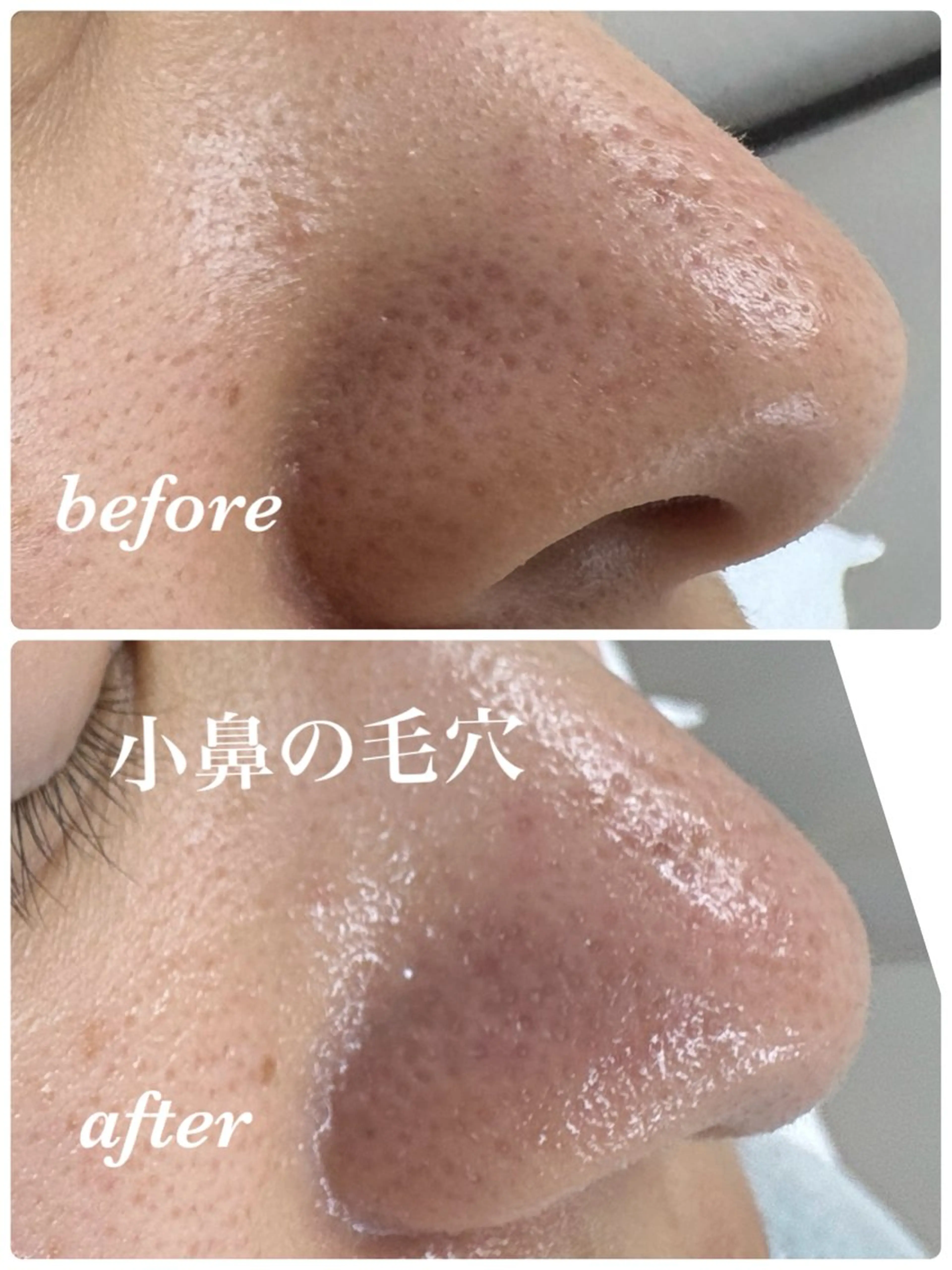 小鼻集中ケア《気になるいちご鼻》の写真