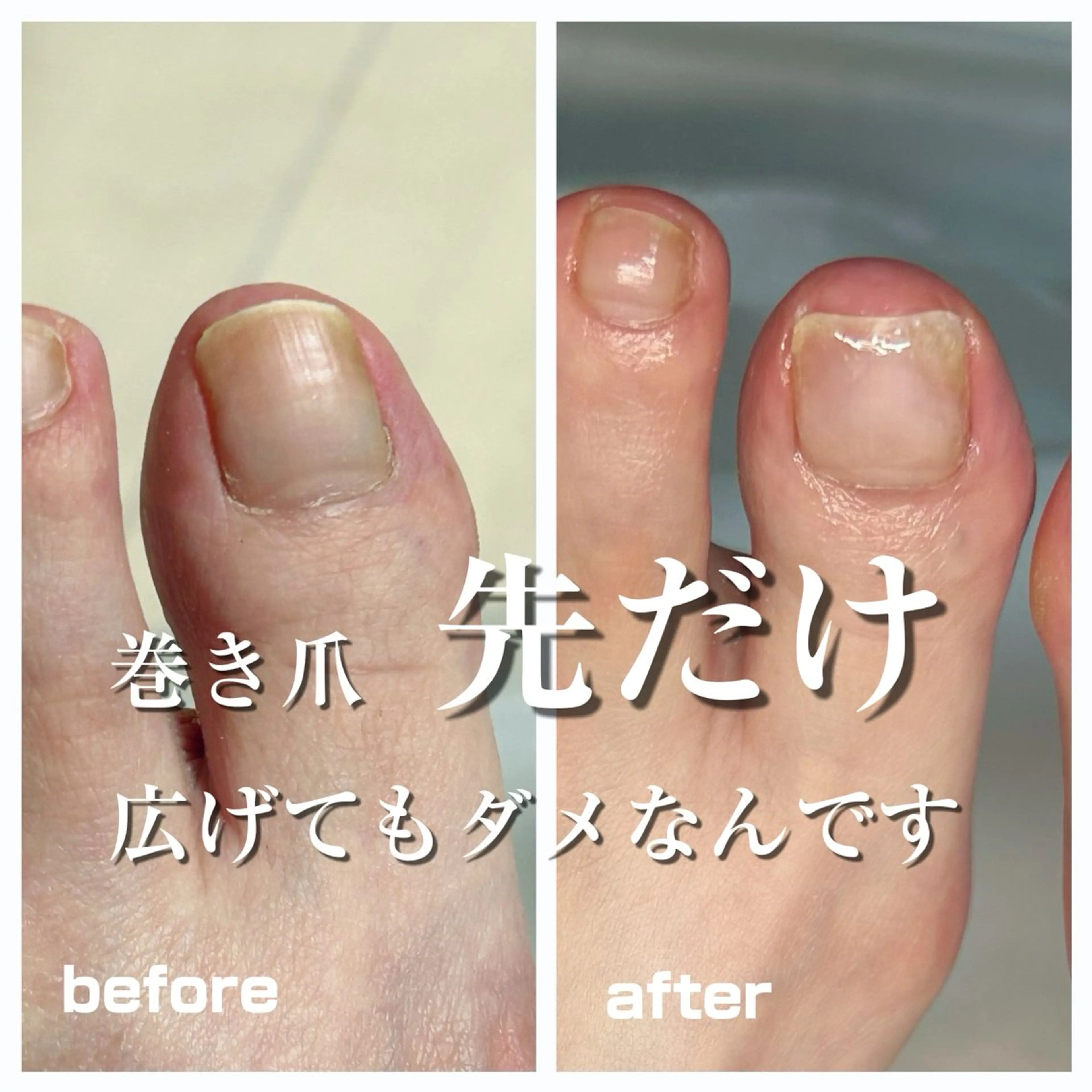 その他 巻き爪フットケアサロンKotori所属・フットケアサロン Kotoriのその他イメージ