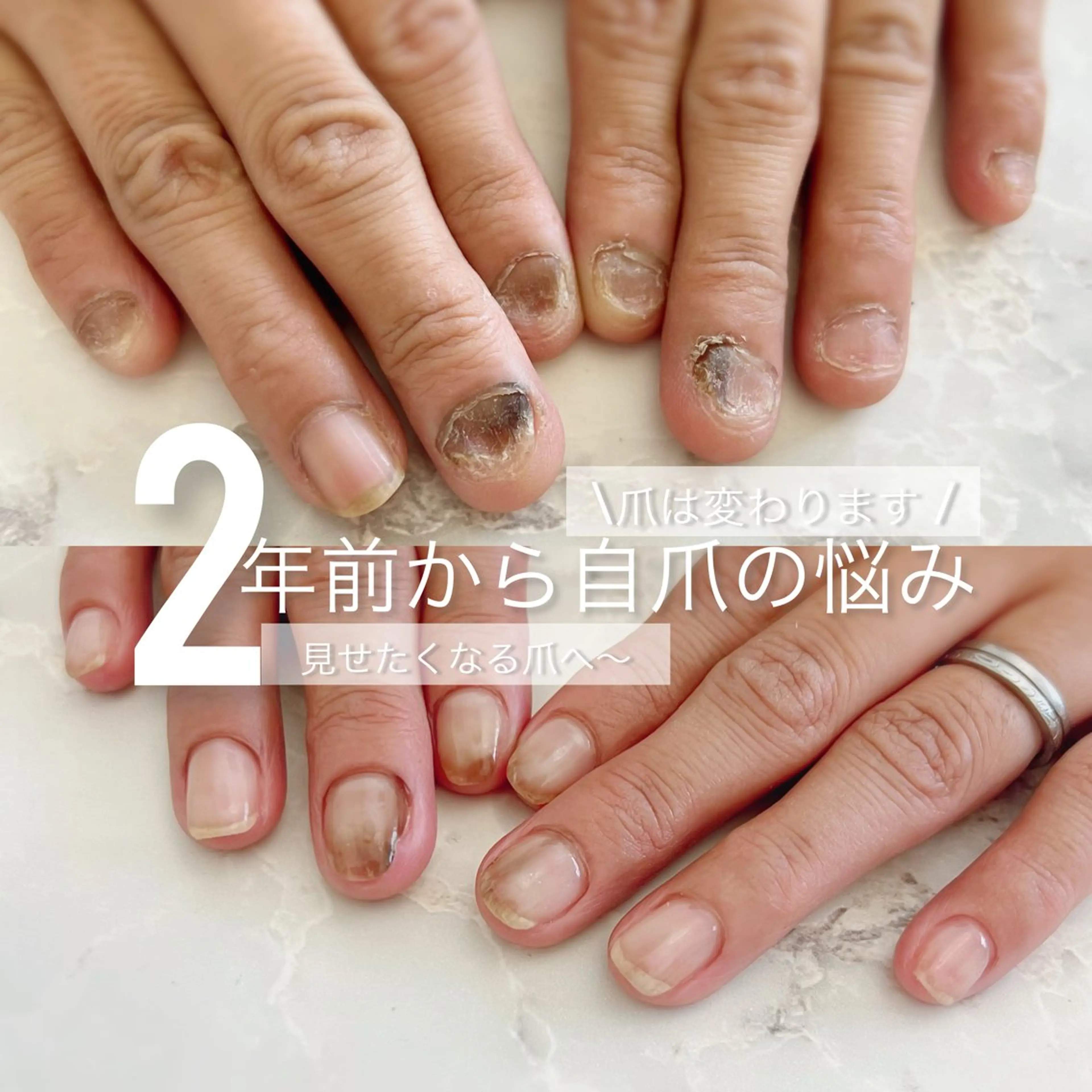 自爪育成❣️❣️メディカルネイル【トラブル爪・コンプレックス爪】モニター価格!!の写真