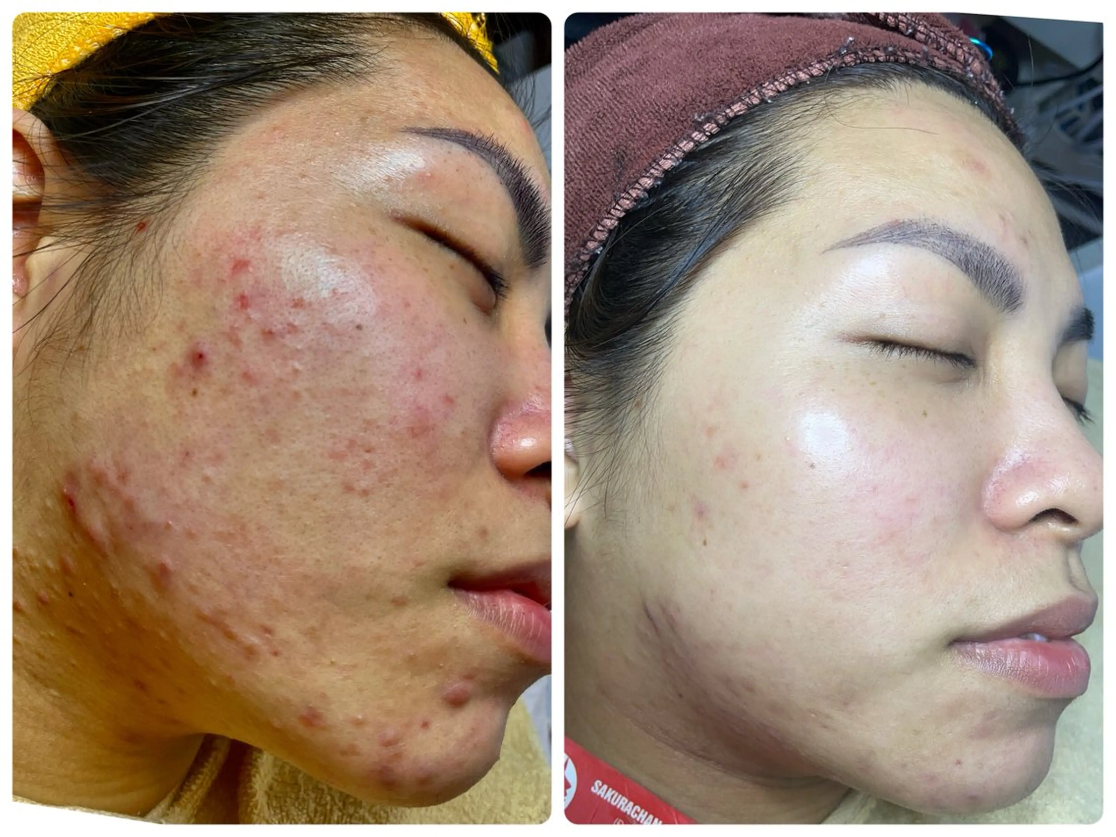 ニキビ、痩身、脱毛、 サクラチャンスパのエステ・リラクイメージ