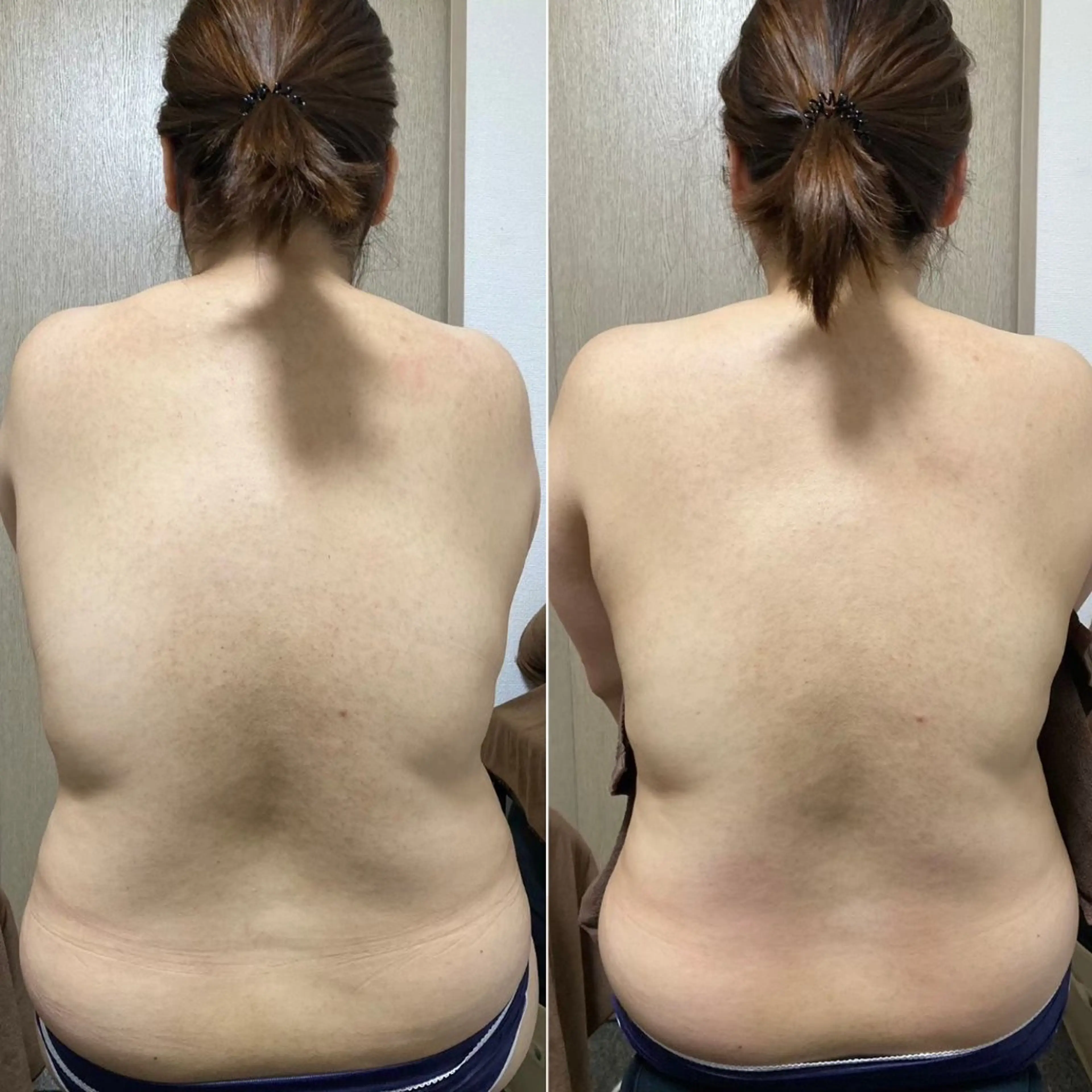 🔥背中美人【すっきりラインケア】背中、二の腕、お腹、上半身ダイエット※施術内容は下記をご覧下さいませの写真