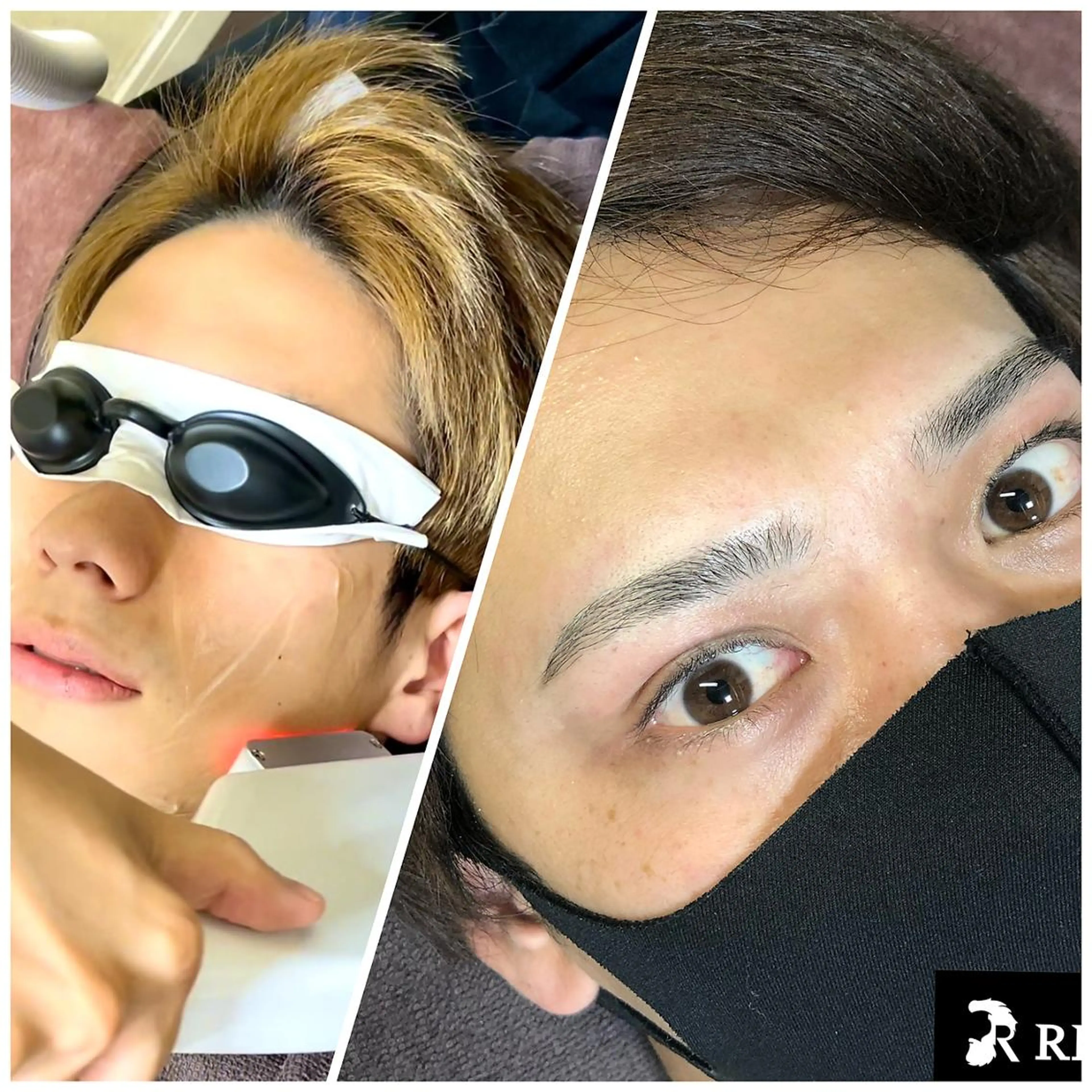 【セットメニュー】眉毛スタイリング＋全顔ヒゲ脱毛セット　\15480→\5980の写真