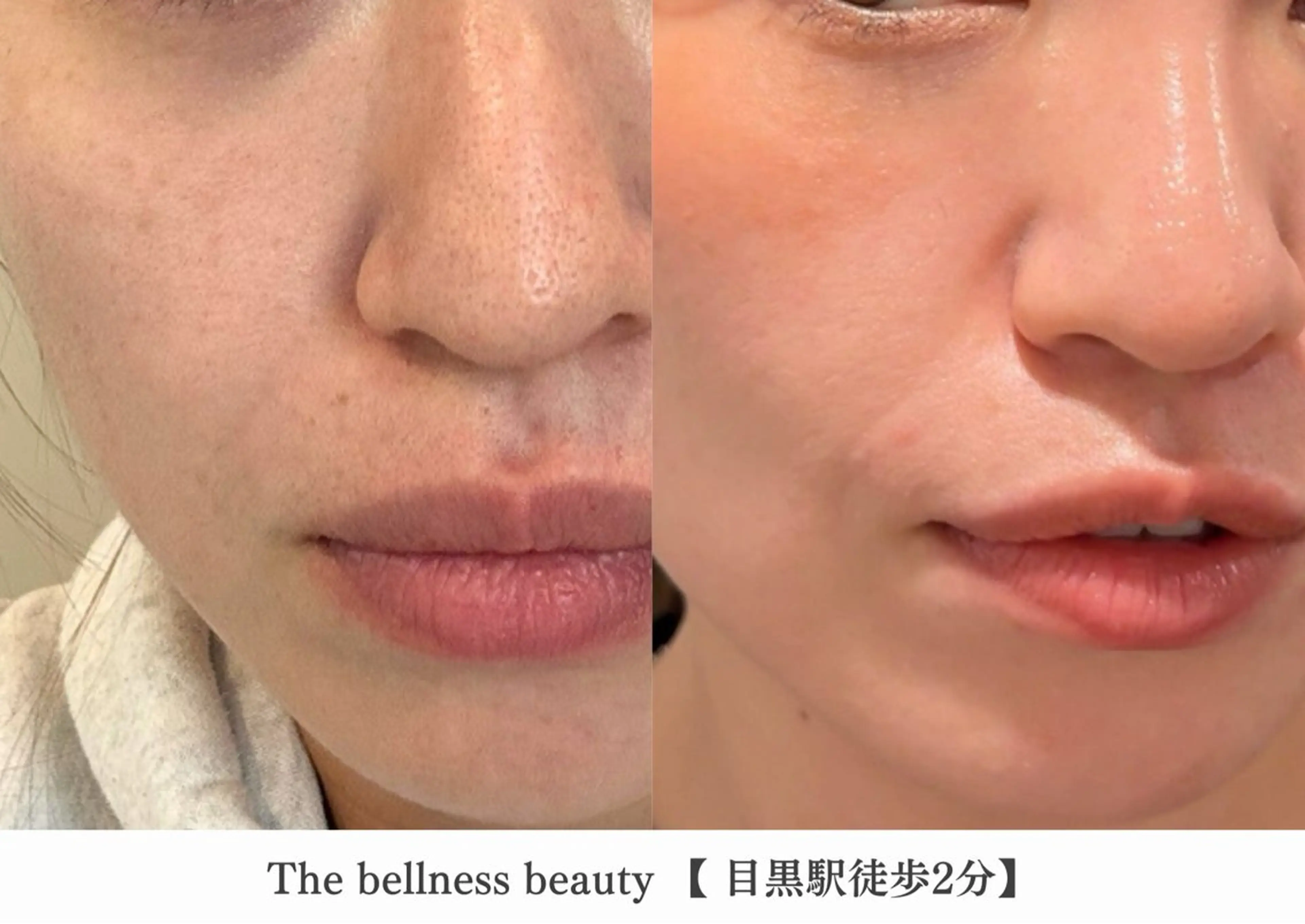 エステ 《毛穴レス美肌》ザ・ ベルネス 目黒駅2分のエステ・リラクイメージ