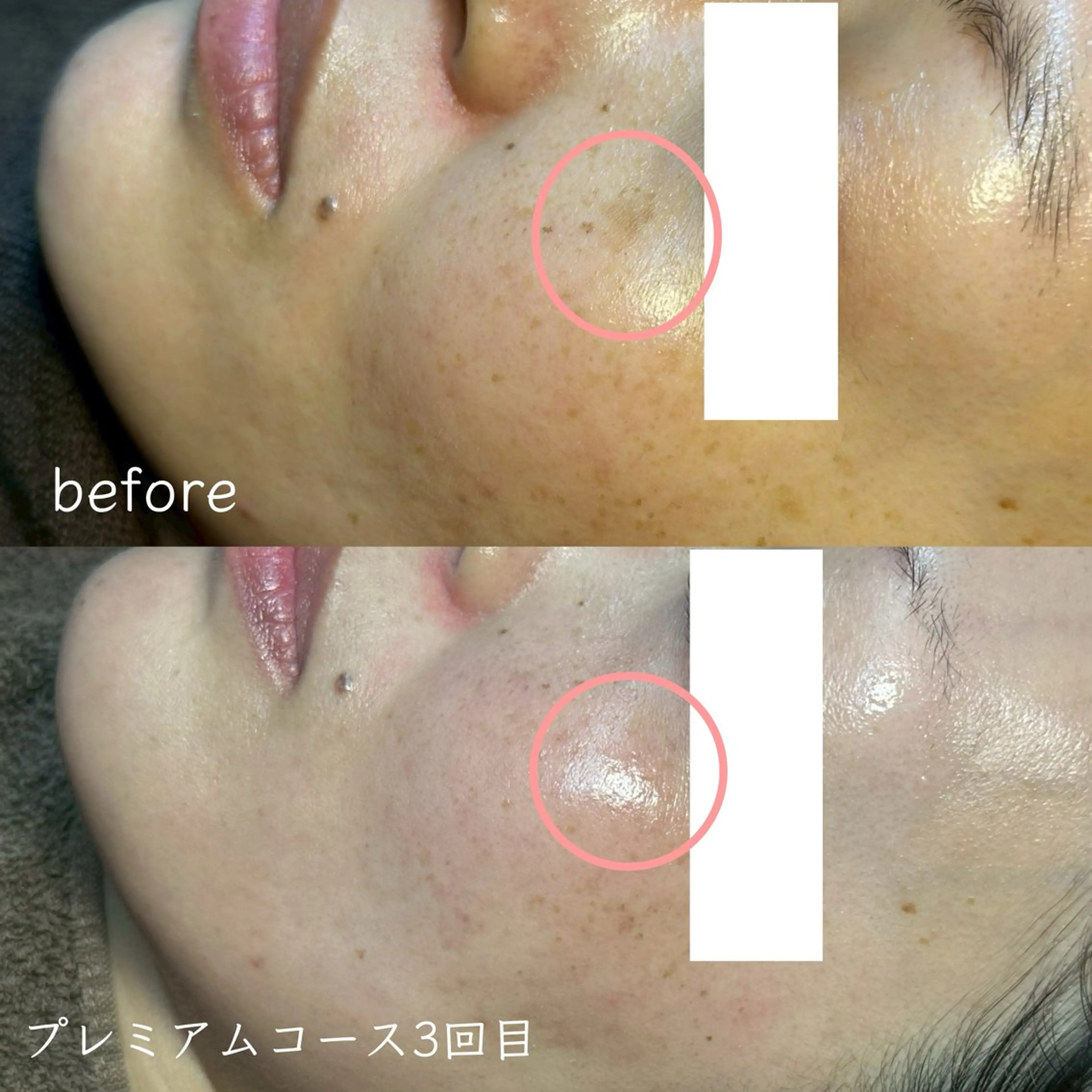 【新規人気No.1☆】肌質改善シミケア《プレミアムコース》90分16,500→9,800の写真