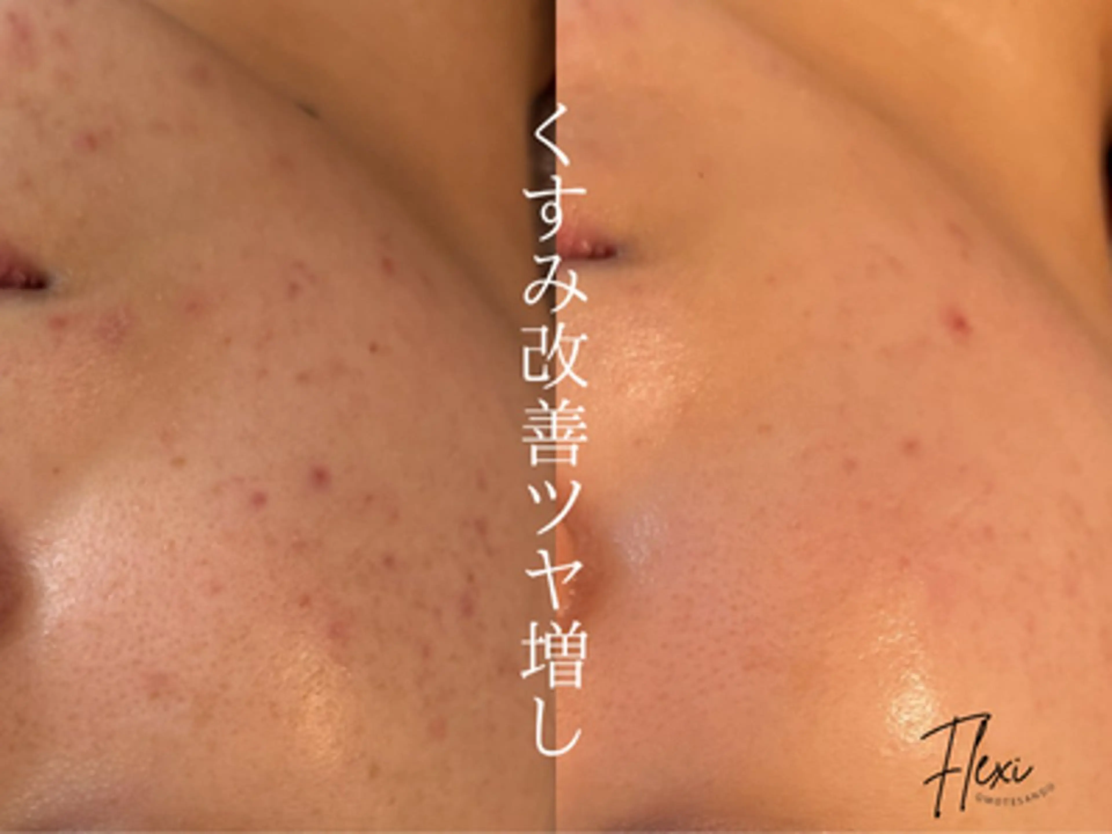 【小顔&美肌の同時ケア】小顔矯正＋毛穴レスピーリングコースの写真