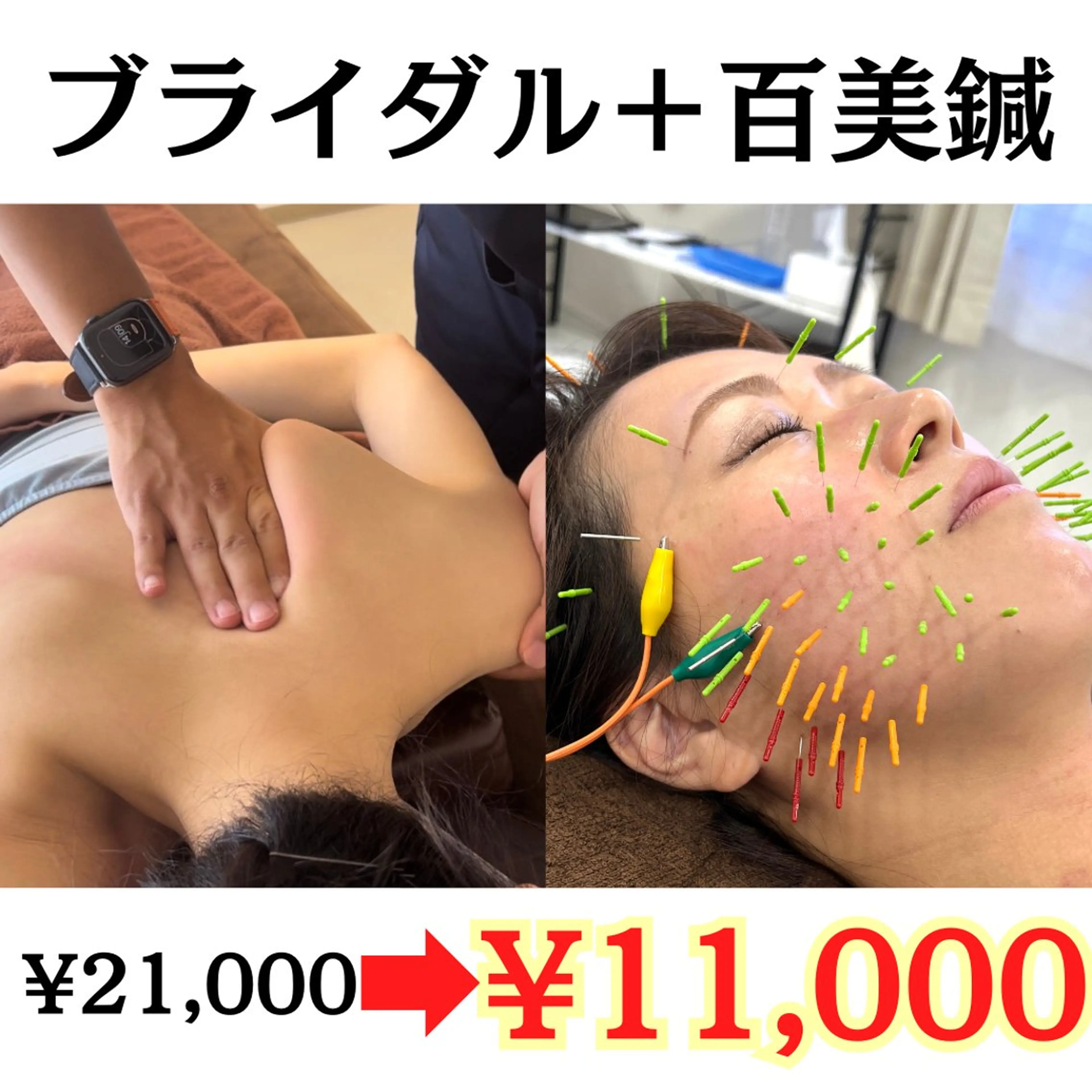 【新規クーポン】ブライダル整体×百美鍼(100分)（美容鍼100本/小顔/肩甲骨はがし/姿勢矯正）の写真