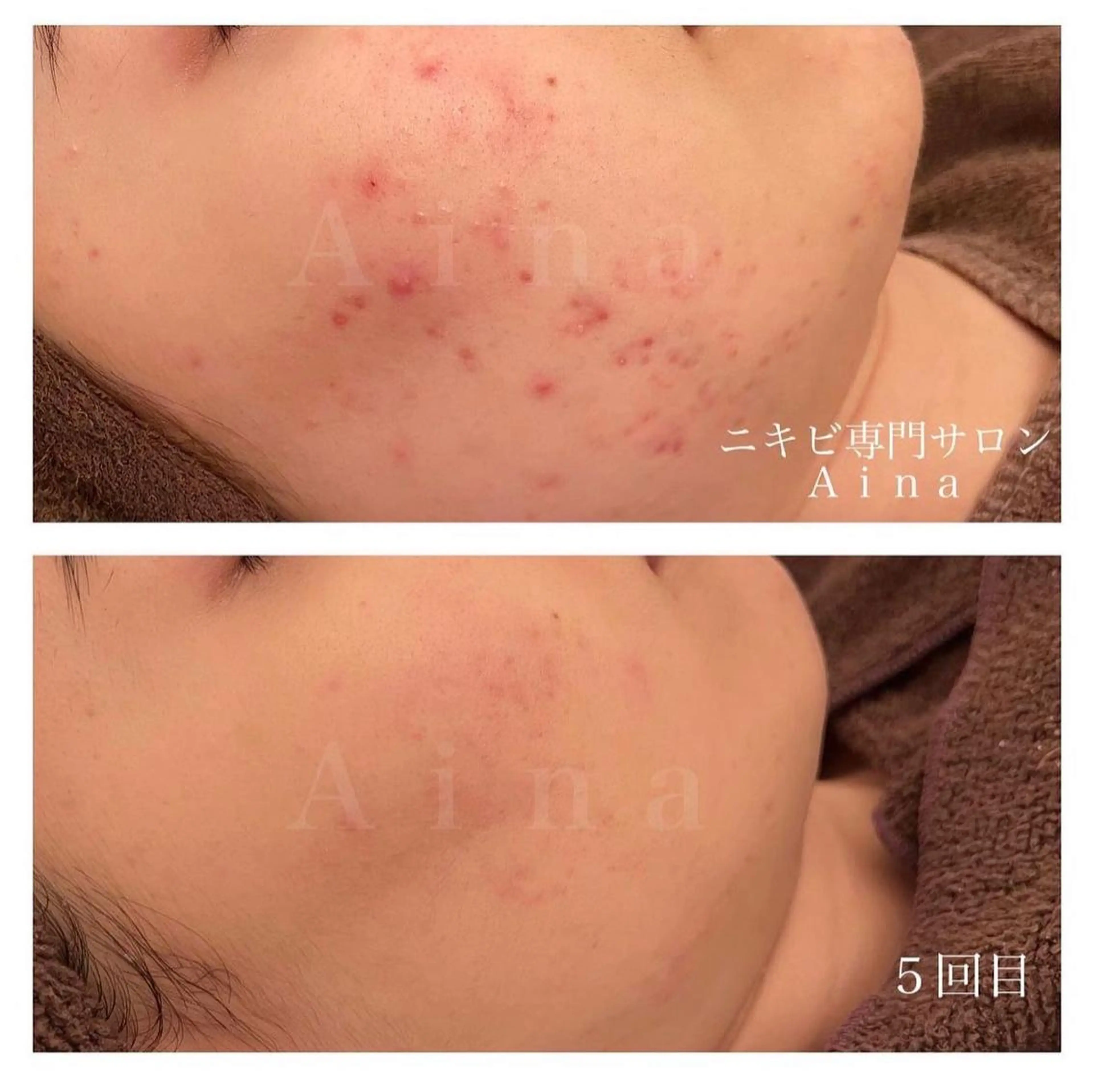 ミディアム パーマ ヘアアレンジ メンズ キッズ ネイル マツエク・マツパ アイブロウ エステ リラク ニキビ跡専門サロン Ａｉｎａのエステ・リラクイメージ