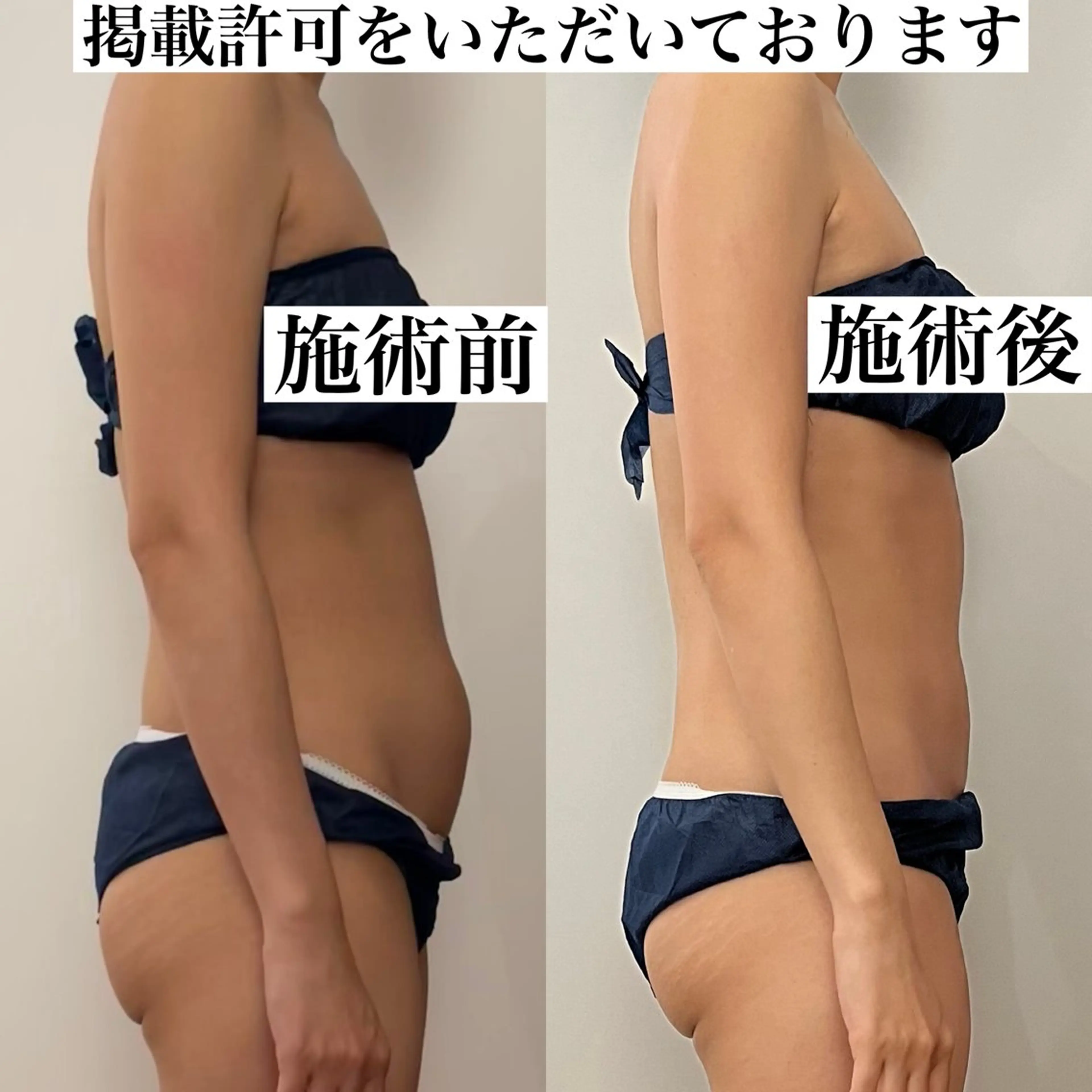 🧖‍♀️筋膜リリース ︎💕︎施術時間40分の写真