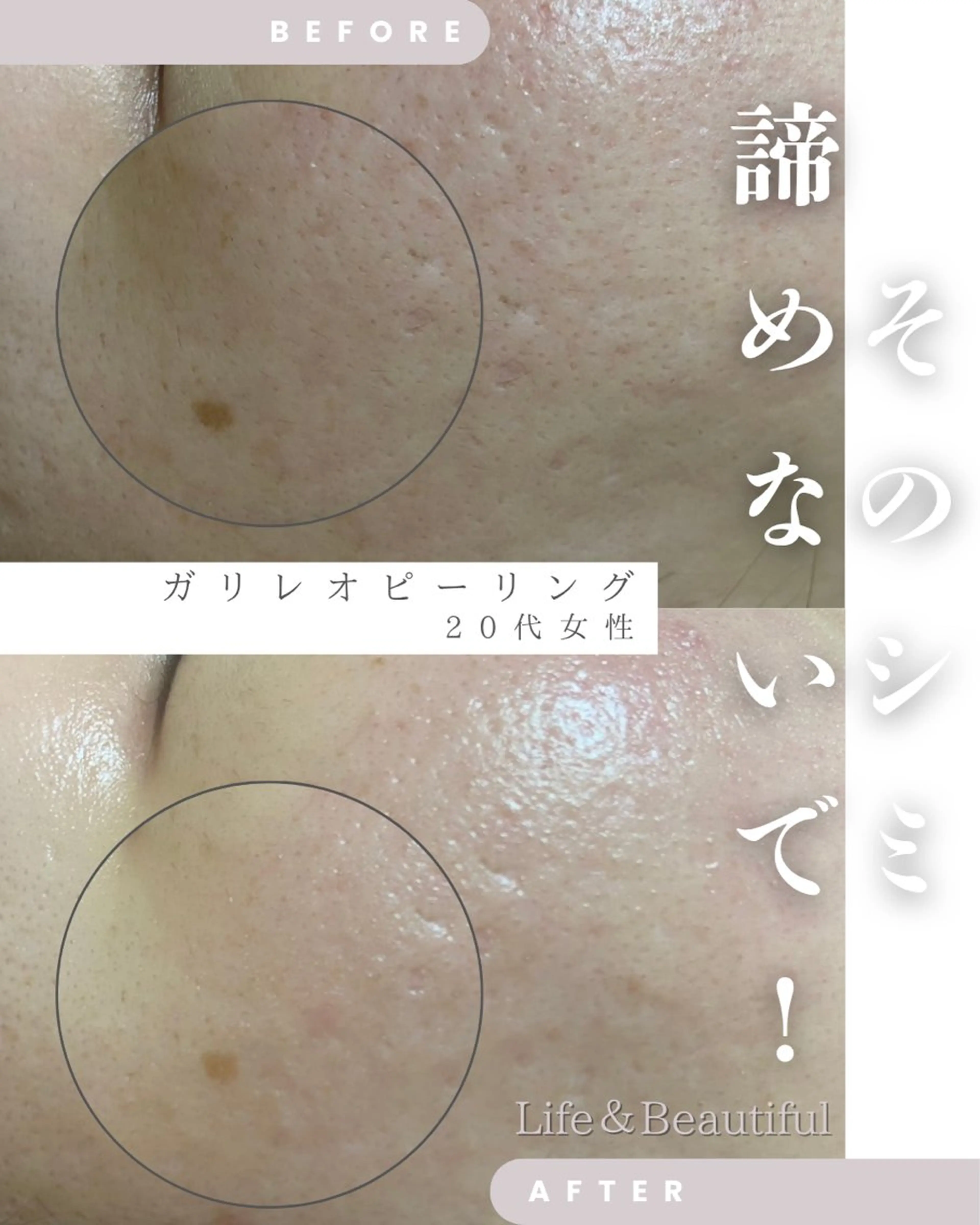 【短期間集中🌟高濃度炭酸美容液ガリレオピーリング】2回目以降❣️嬉しい!デコルテマッサージ付き❣️の写真