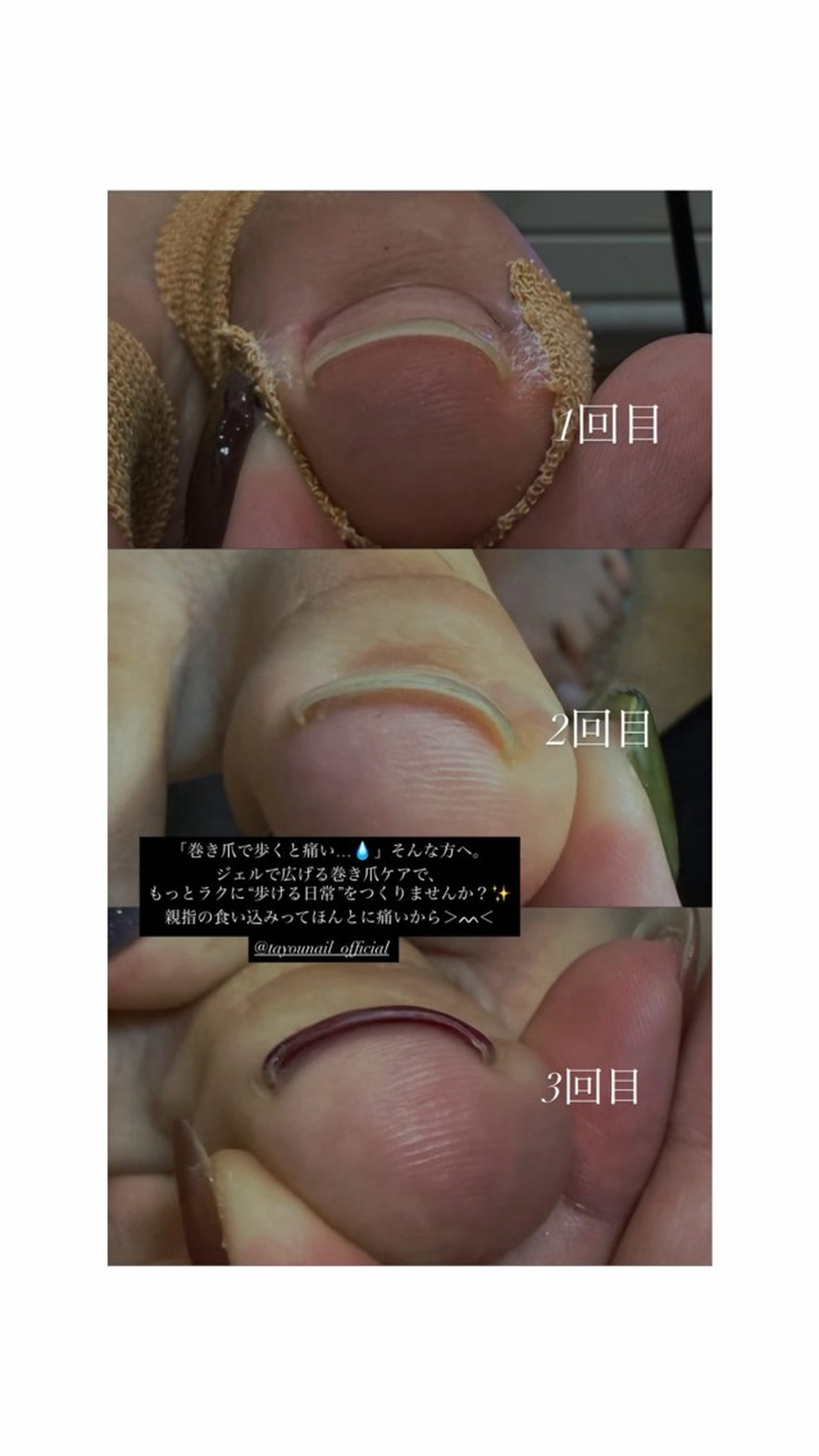 【初回モニター価格📸】巻き爪ケアコースの写真