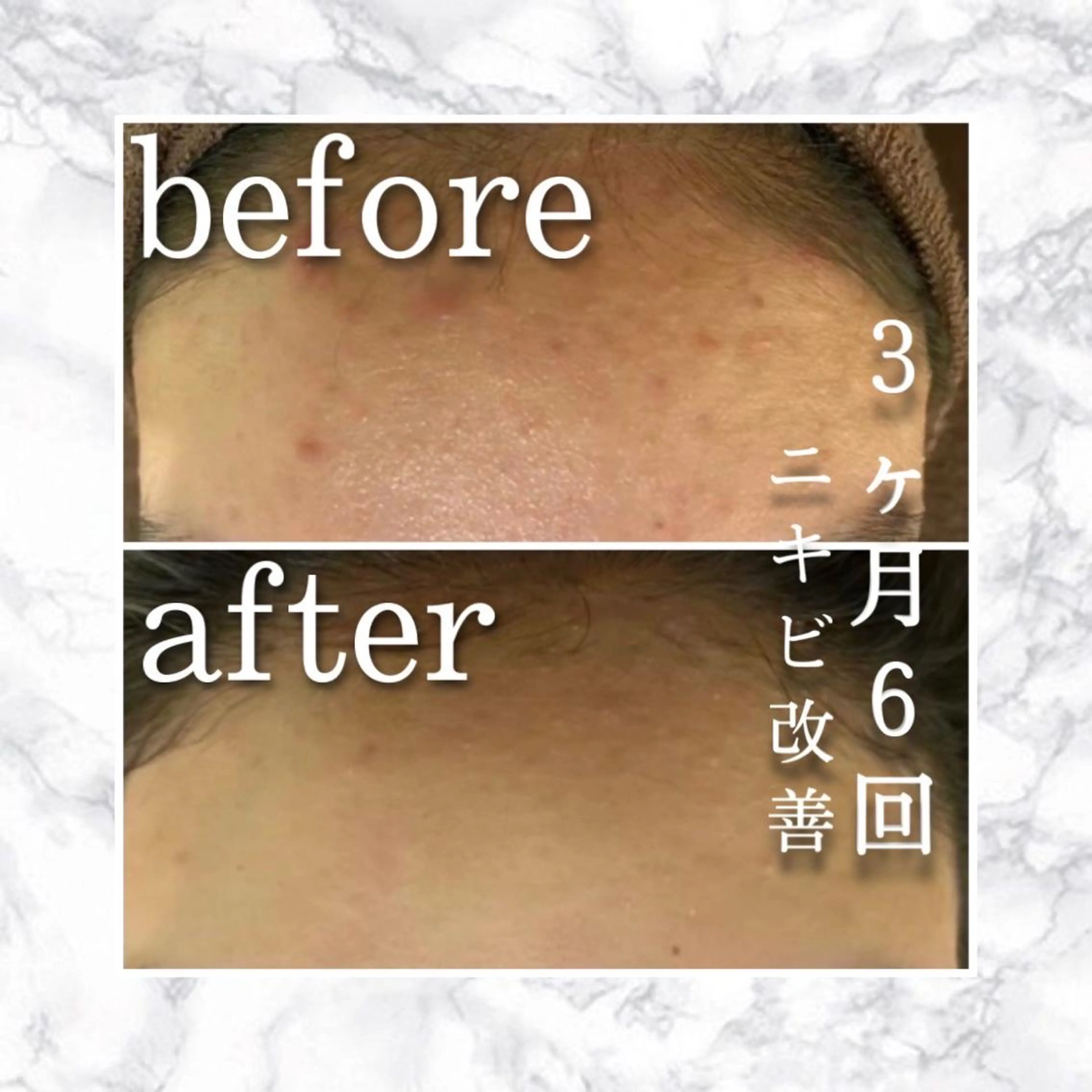 セミロング パーマ ヘアアレンジ メンズ ネイル マツエク・マツパ アイブロウ エステ リラク ニキビ特化型エステ 🍋最短で肌質改善のエステ・リラクイメージ
