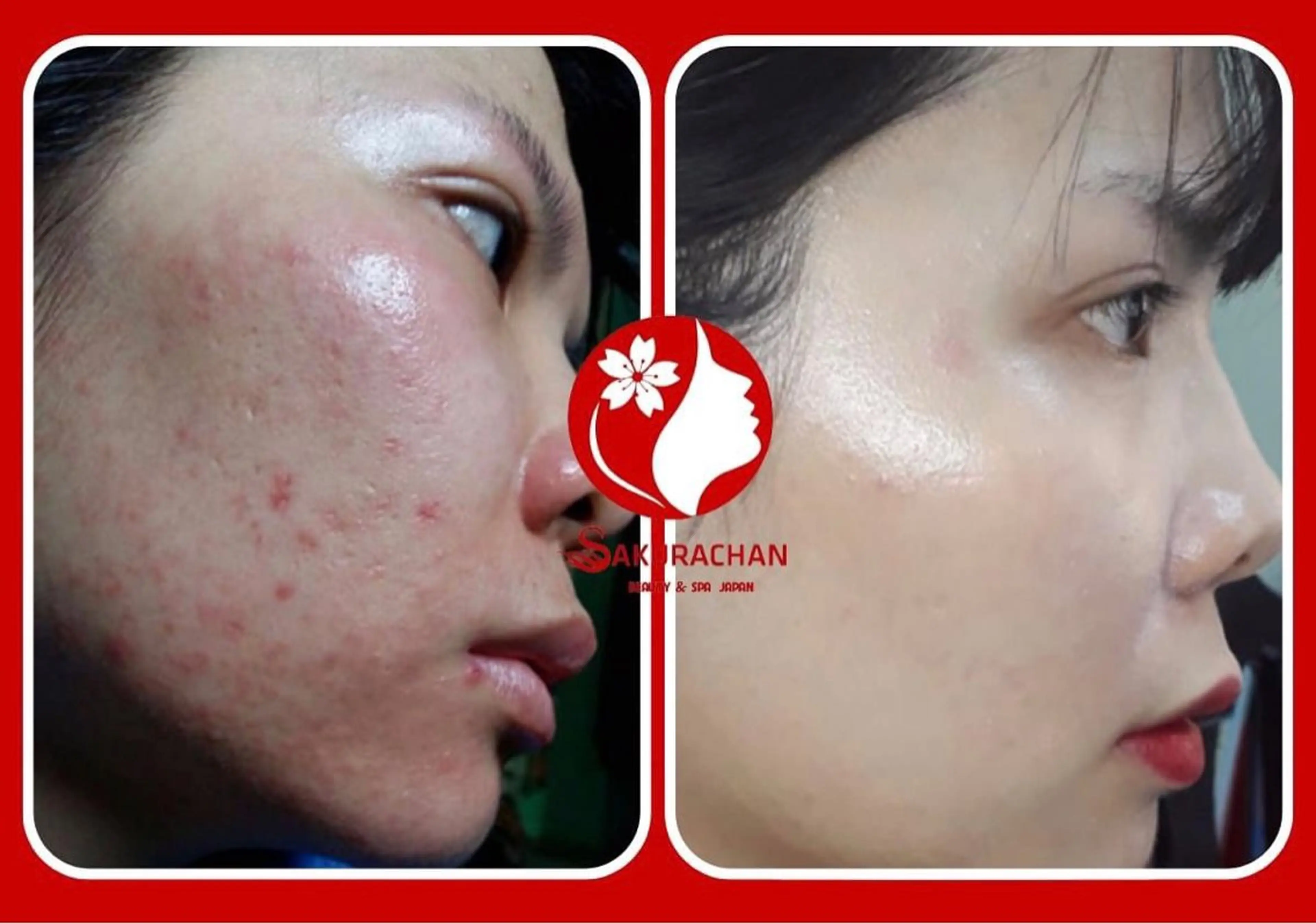 ニキビ、痩身、脱毛、 サクラチャンスパのエステ・リラクイメージ