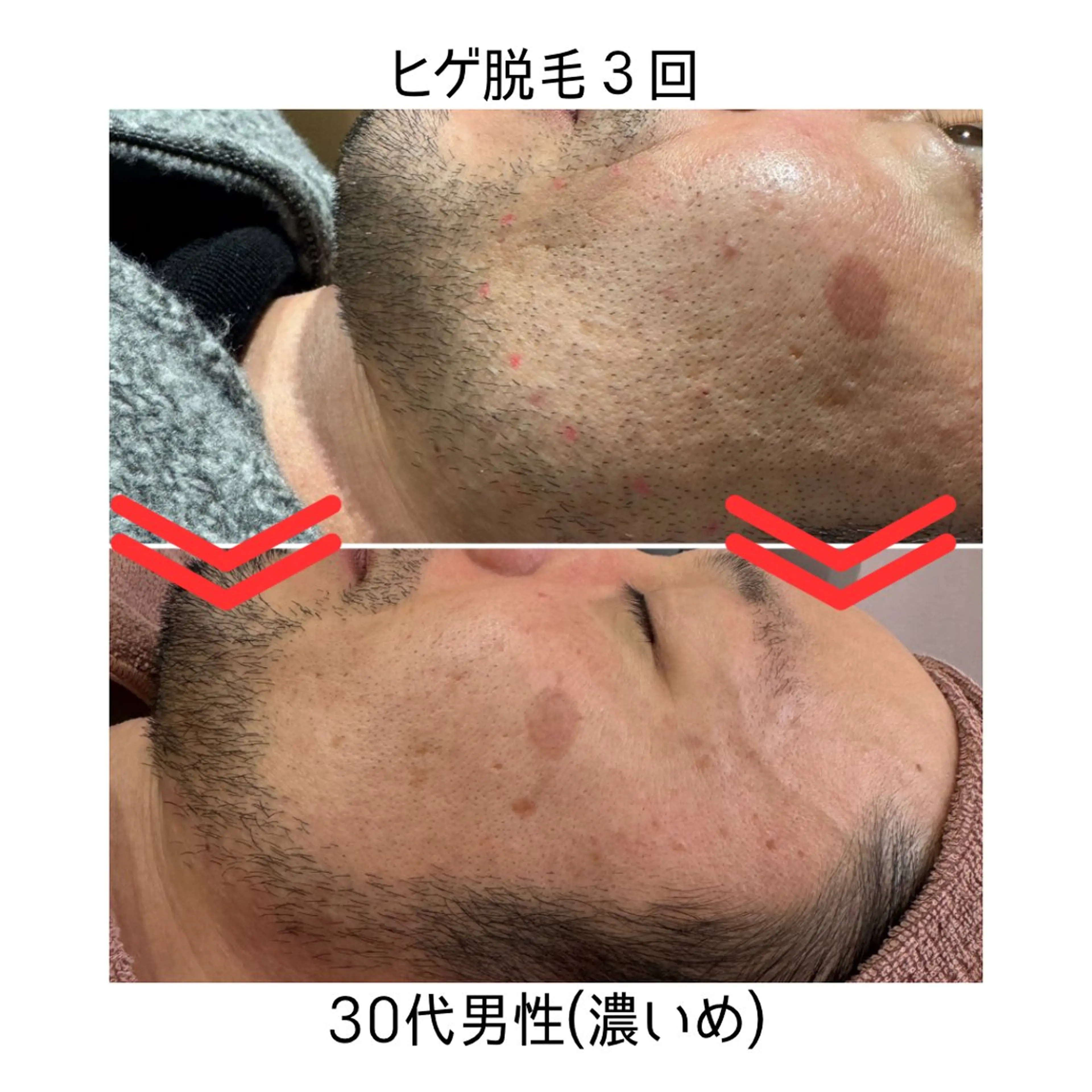 【メンズ】ヒゲ脱毛(目から下全体)の写真