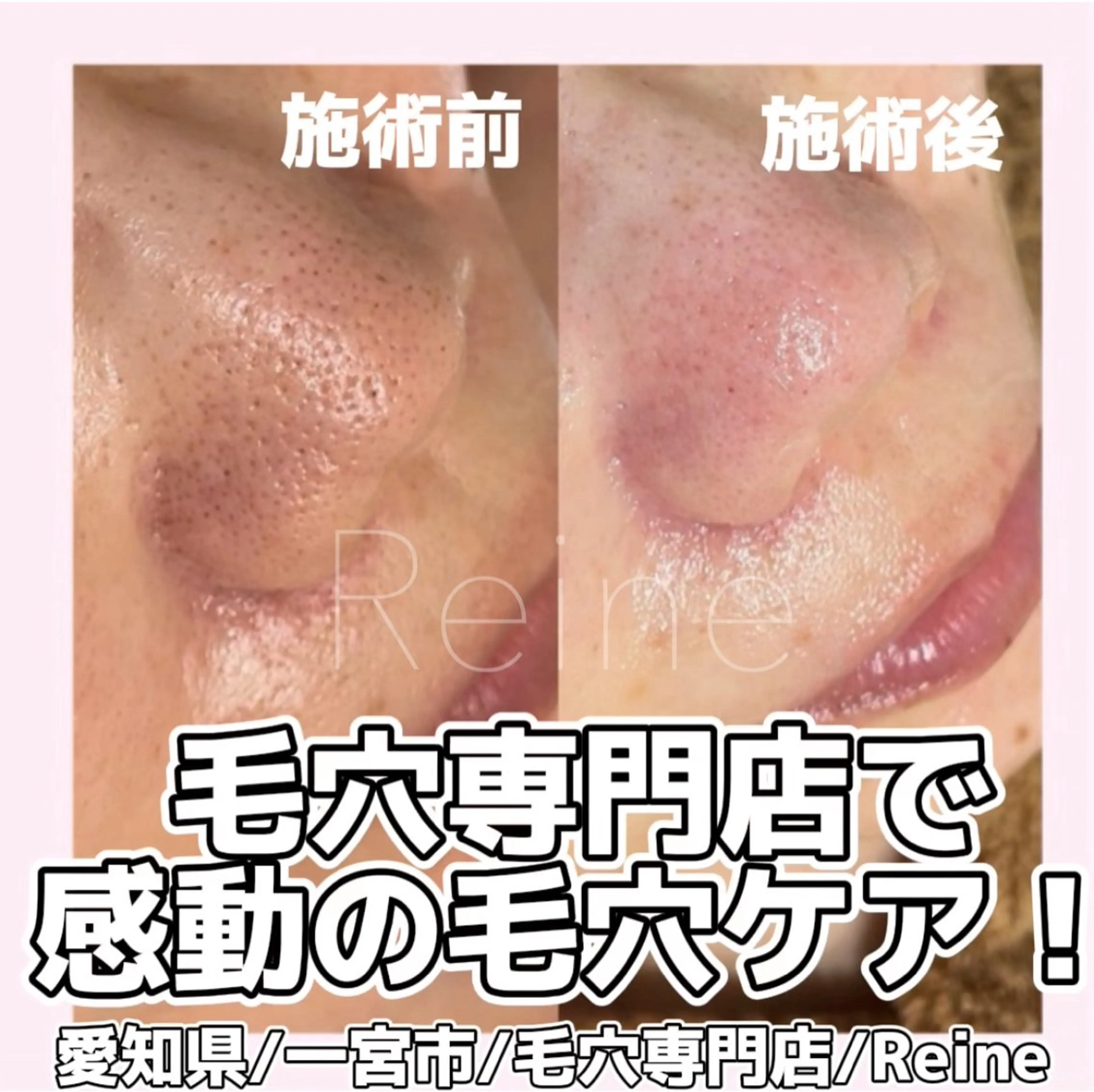 エステ Reine BeautySalon所属・毛穴/シミ肝斑/脱毛 横山梨里のエステ・リラクイメージ