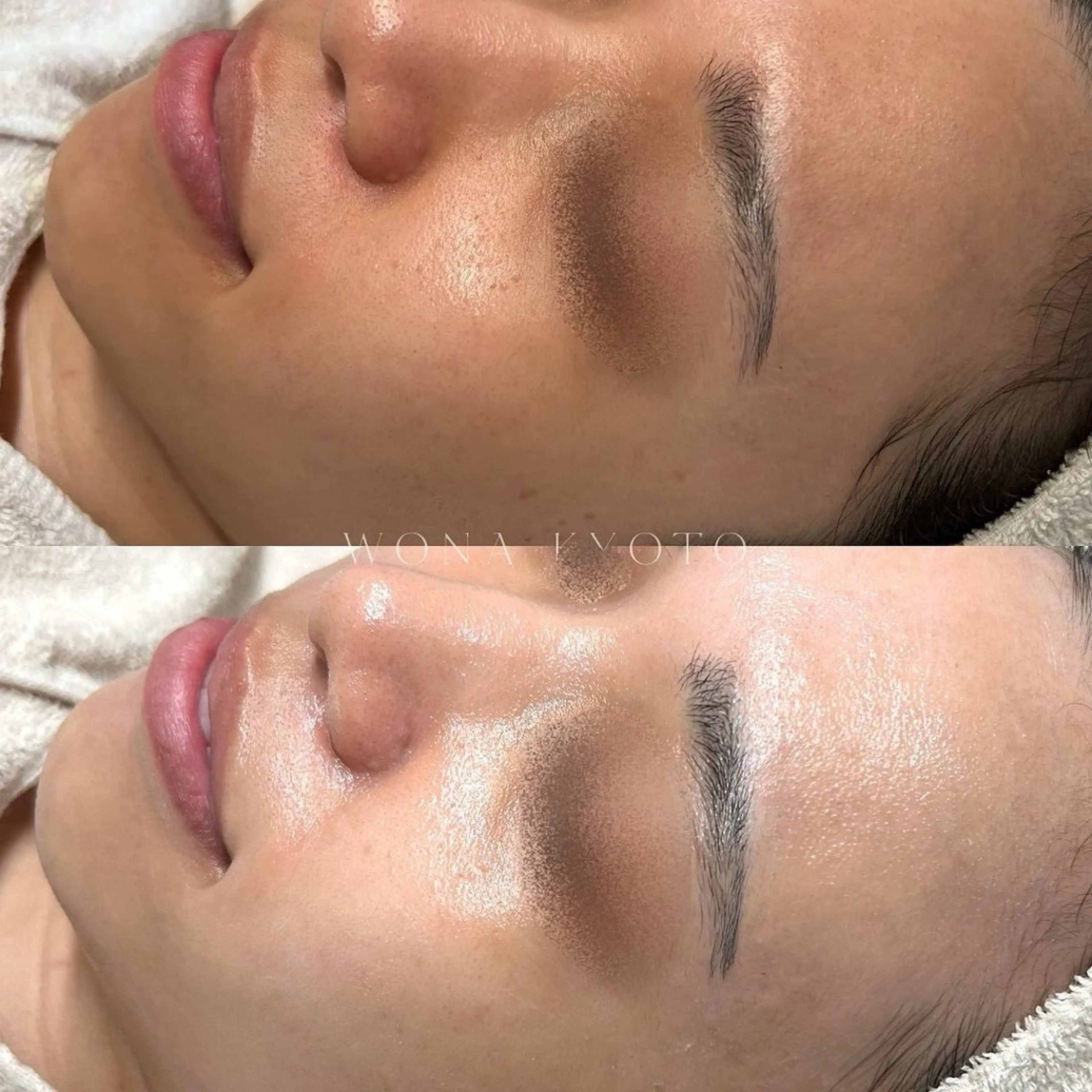 【美白/シミケア/光彩管理】くすみ改善トーンアップ!自分史上最も白く明るい肌へ◎白玉酸素セラピー+ラティニックス管理の写真