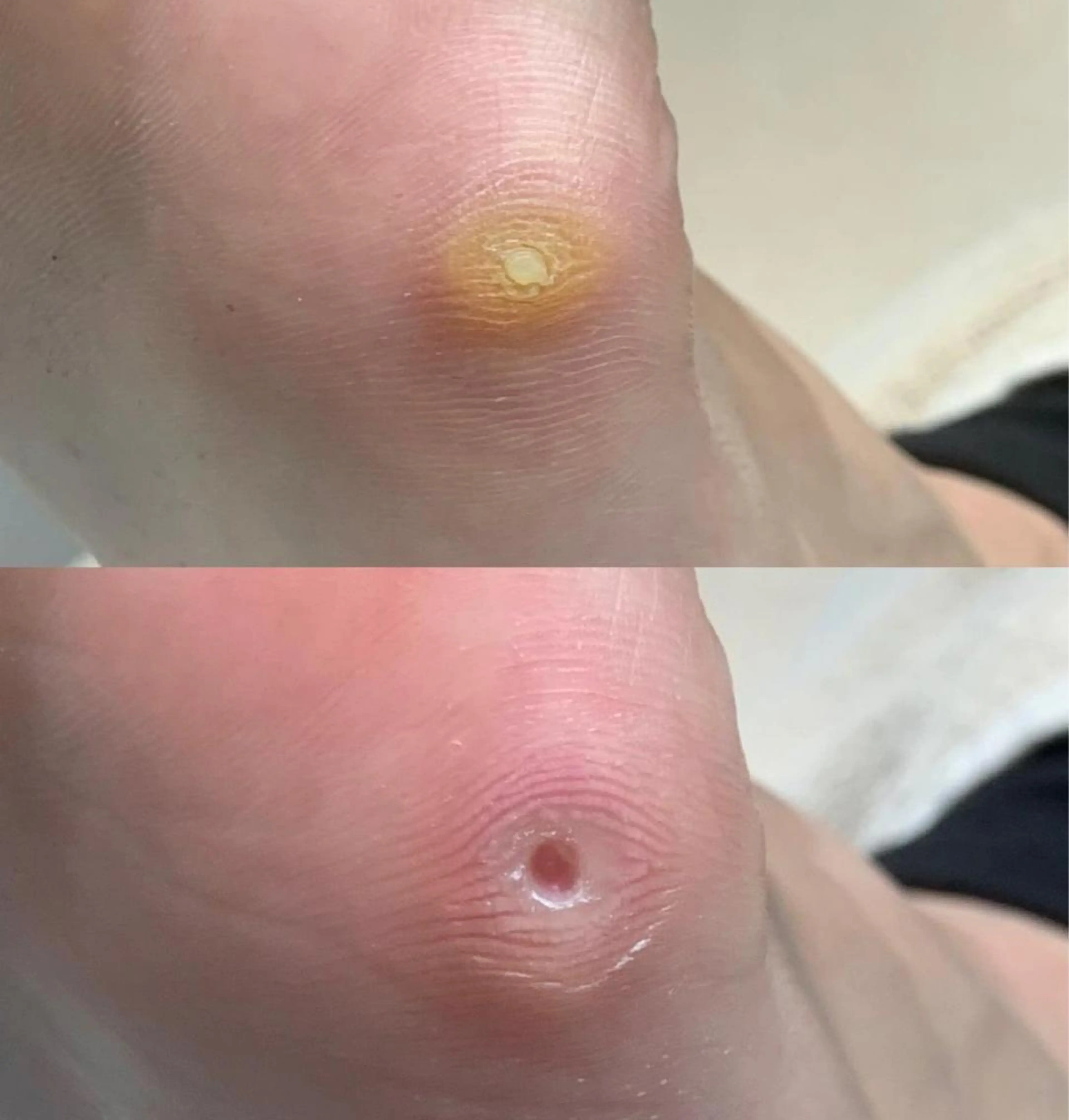 【魚の目ケア】🉐🉐【再来店4週間以内限定❕】足裏の痛い魚の目をキレイに取り除きます✨の写真
