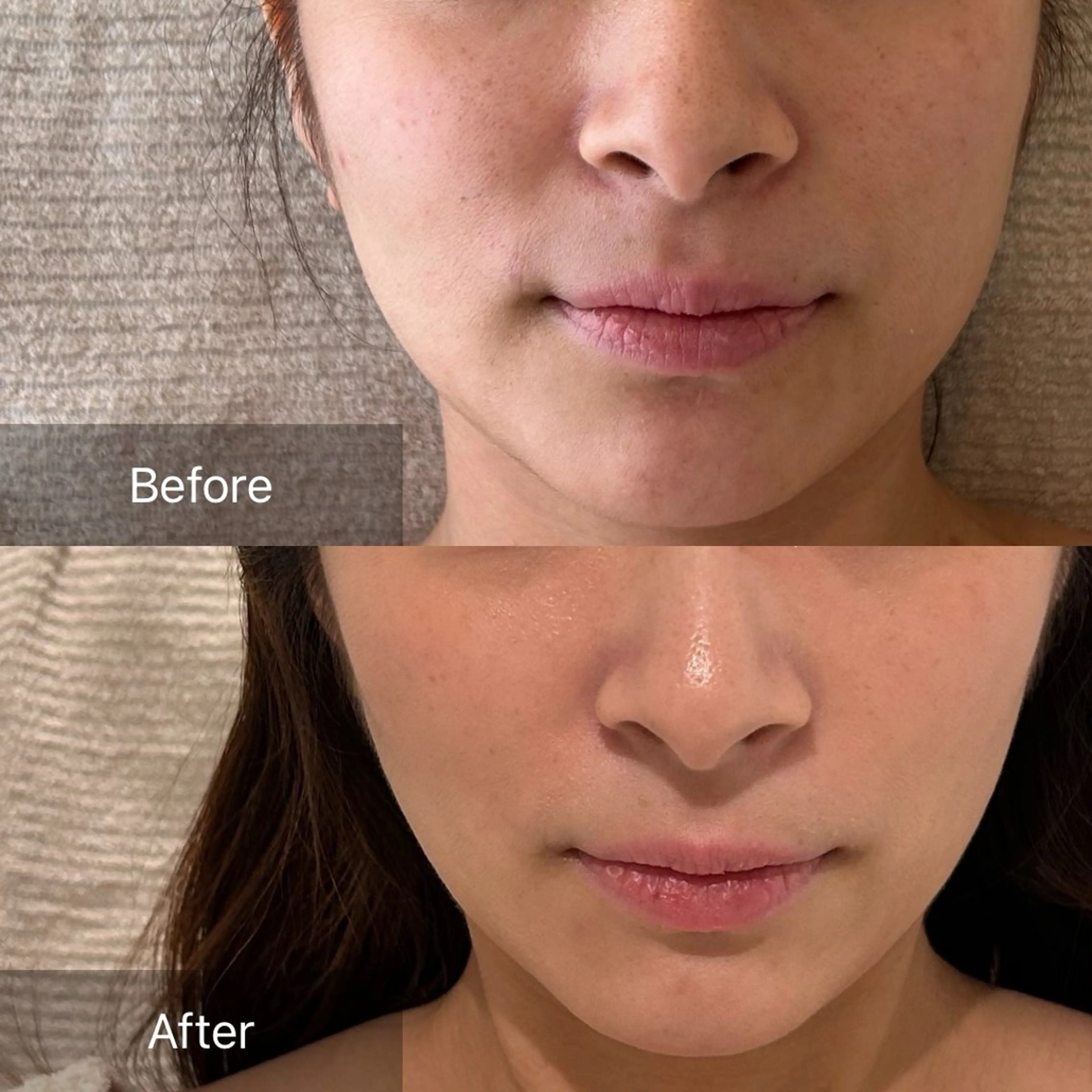 メスなしで衝撃の整形級小顔🍋2ccの写真