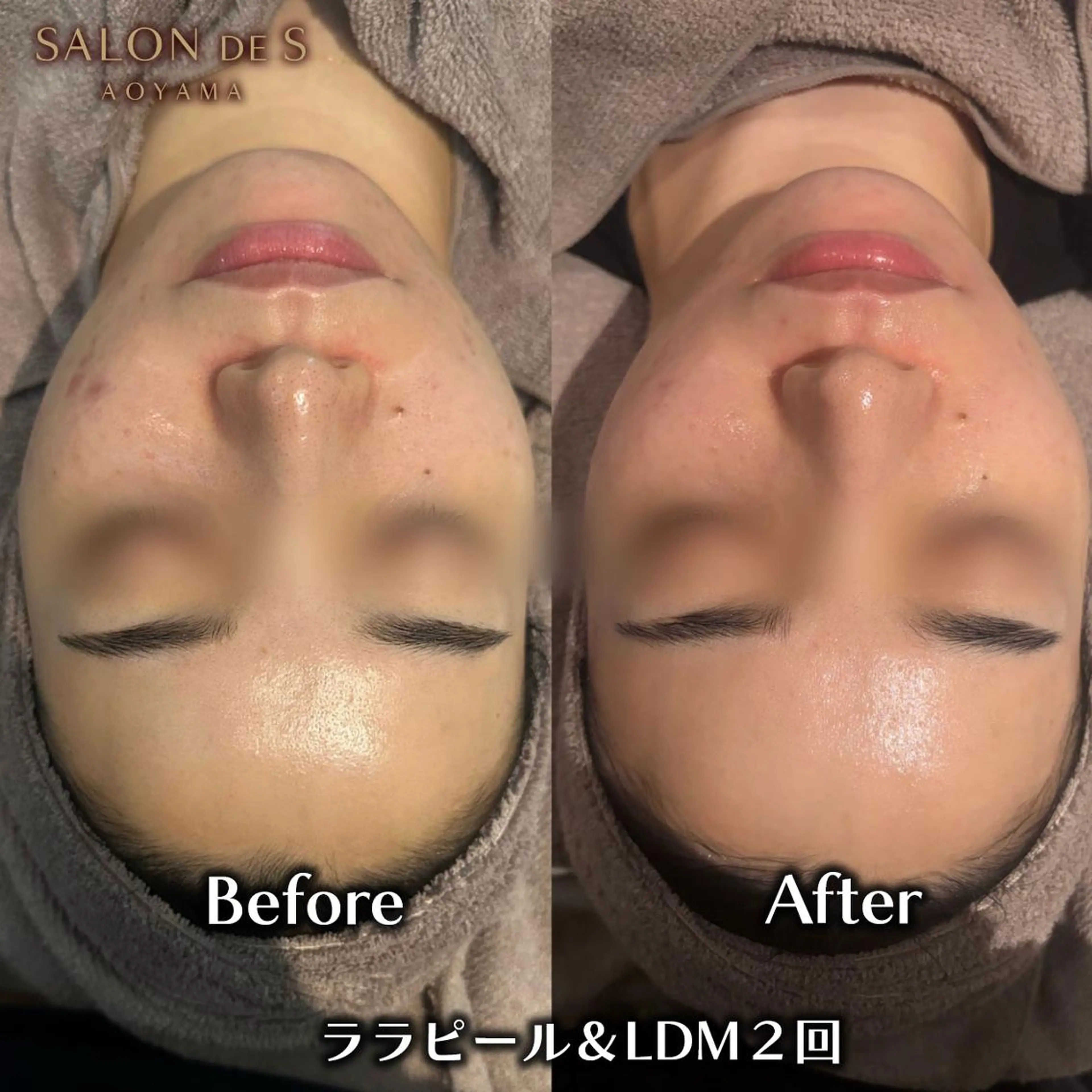 ララピール×WINBACKで叶えるツヤ肌&フェイスリフト!高周波リフトで憧れのツヤ小顔に♡の写真