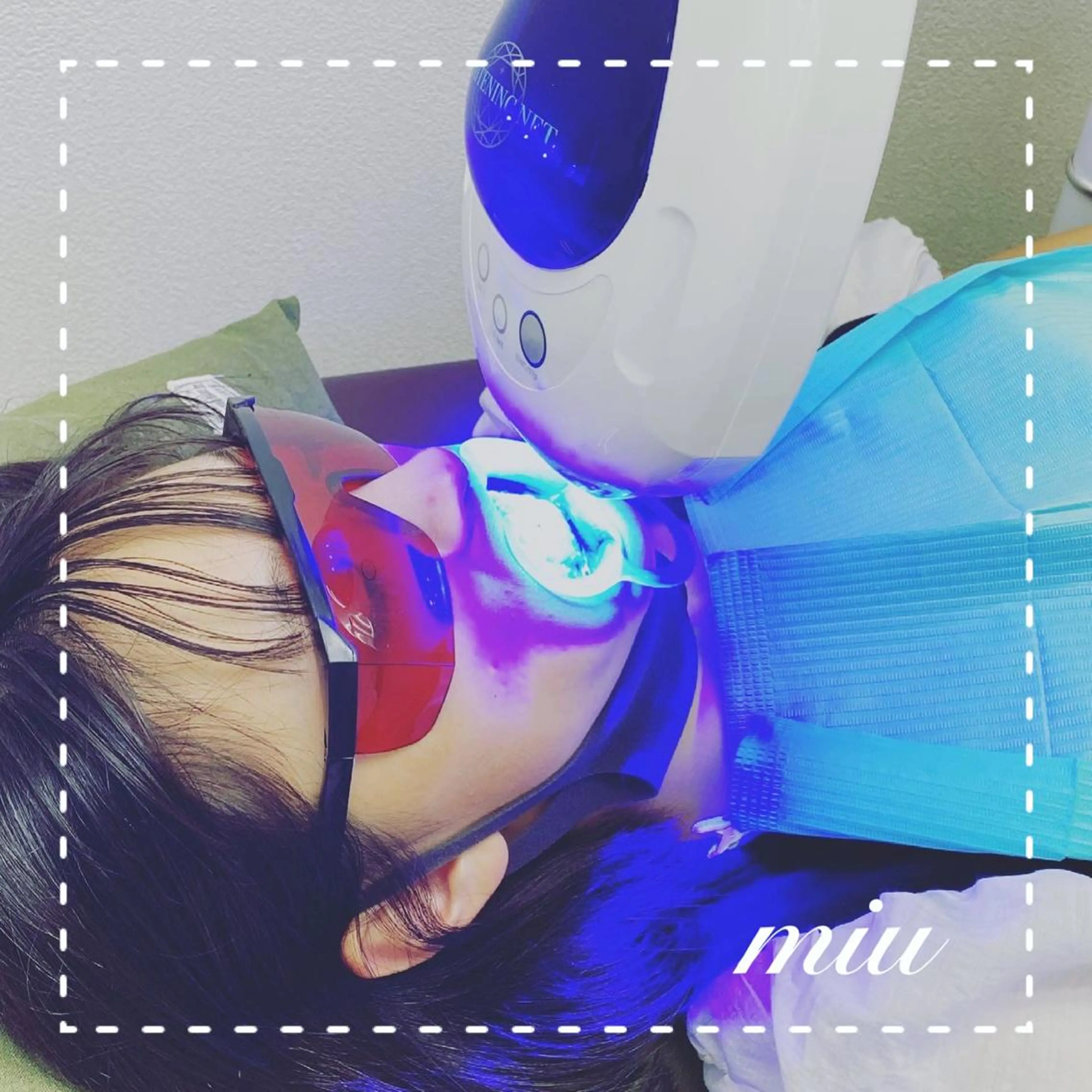 セルフホワイトニングの写真