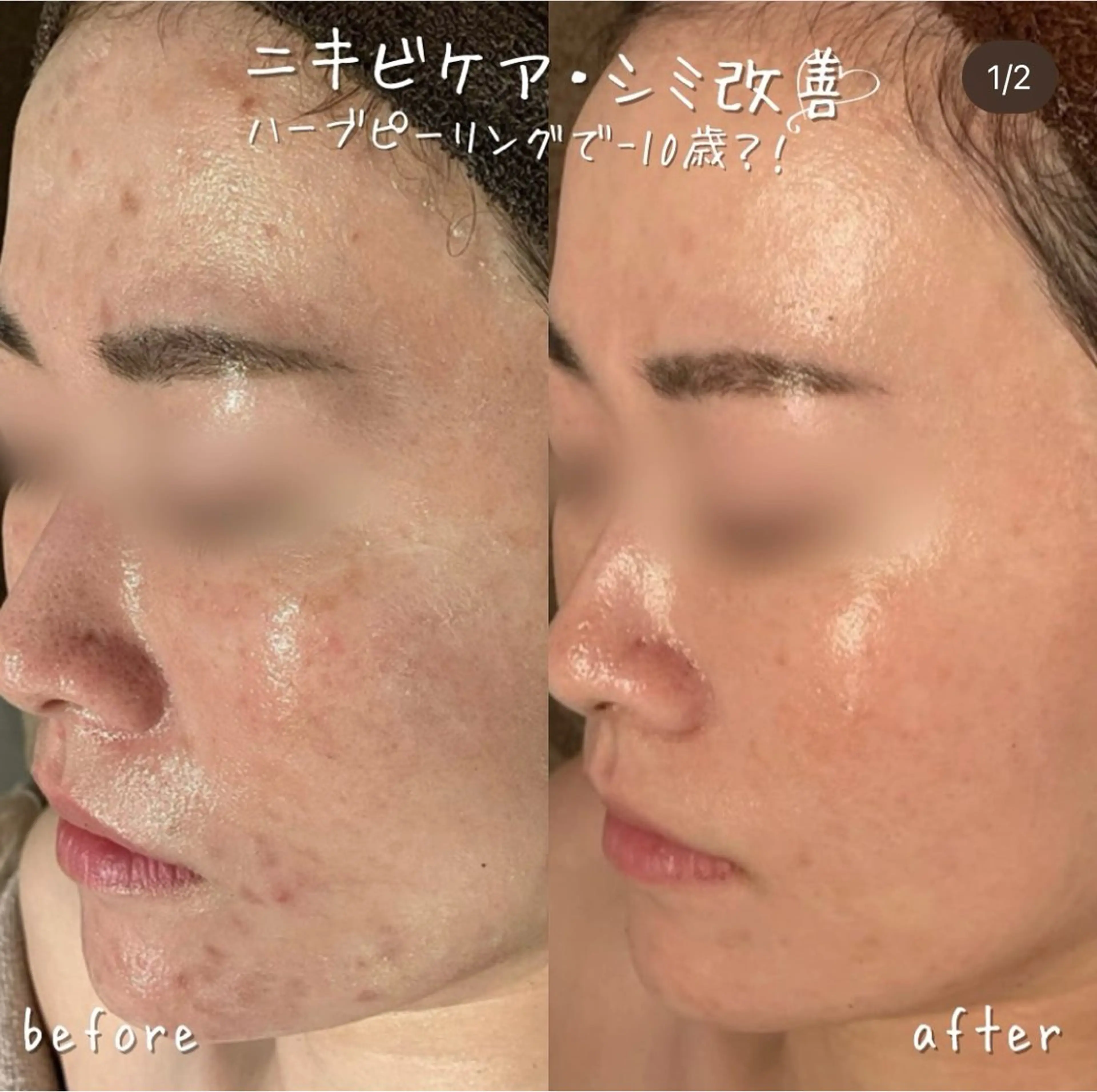 【ハーブピーリング/毛穴洗浄】NA skin 川崎店〜ニキビ・毛穴専門店〜所属・NAskin川崎 皆川のエステ・リラクイメージ
