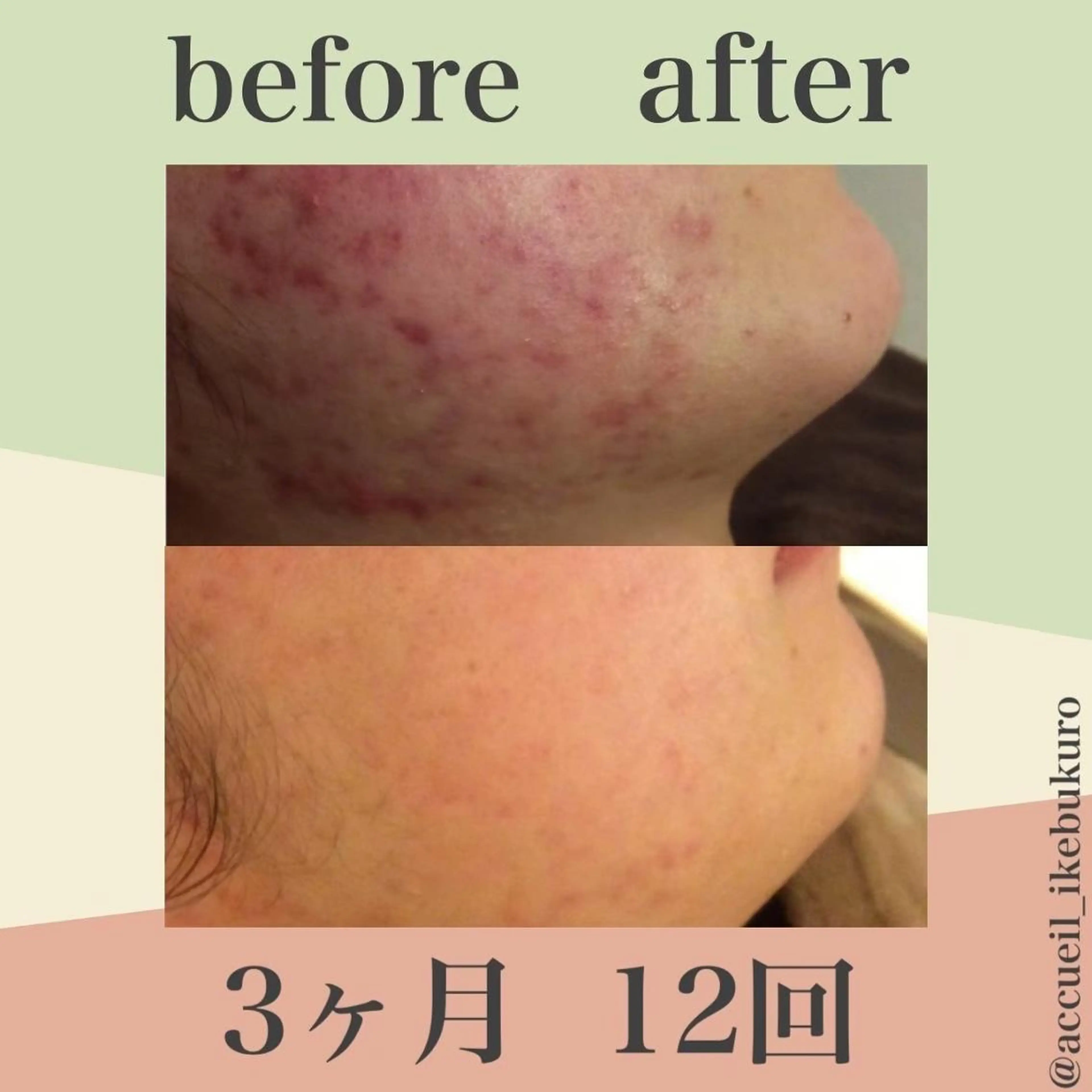皮膚科より効果あり ⁉️最短ニキビ改善のエステ・リラクイメージ