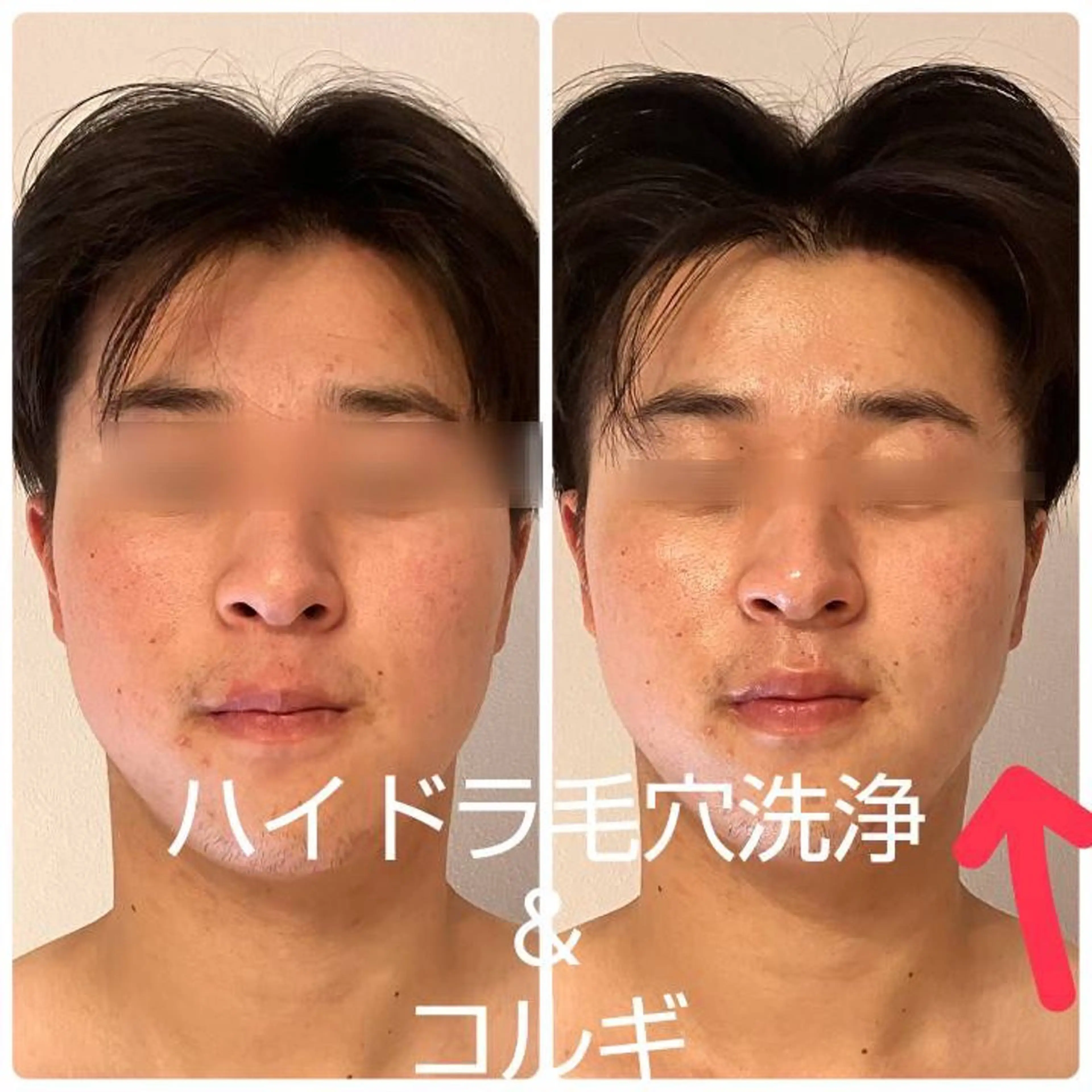 メンズの方！最強美肌ケア！毛穴黒ずみ、ハイドラ毛穴洗浄x小顔コルギ 徹底的に美肌を目指したい！そんな方に◎の写真