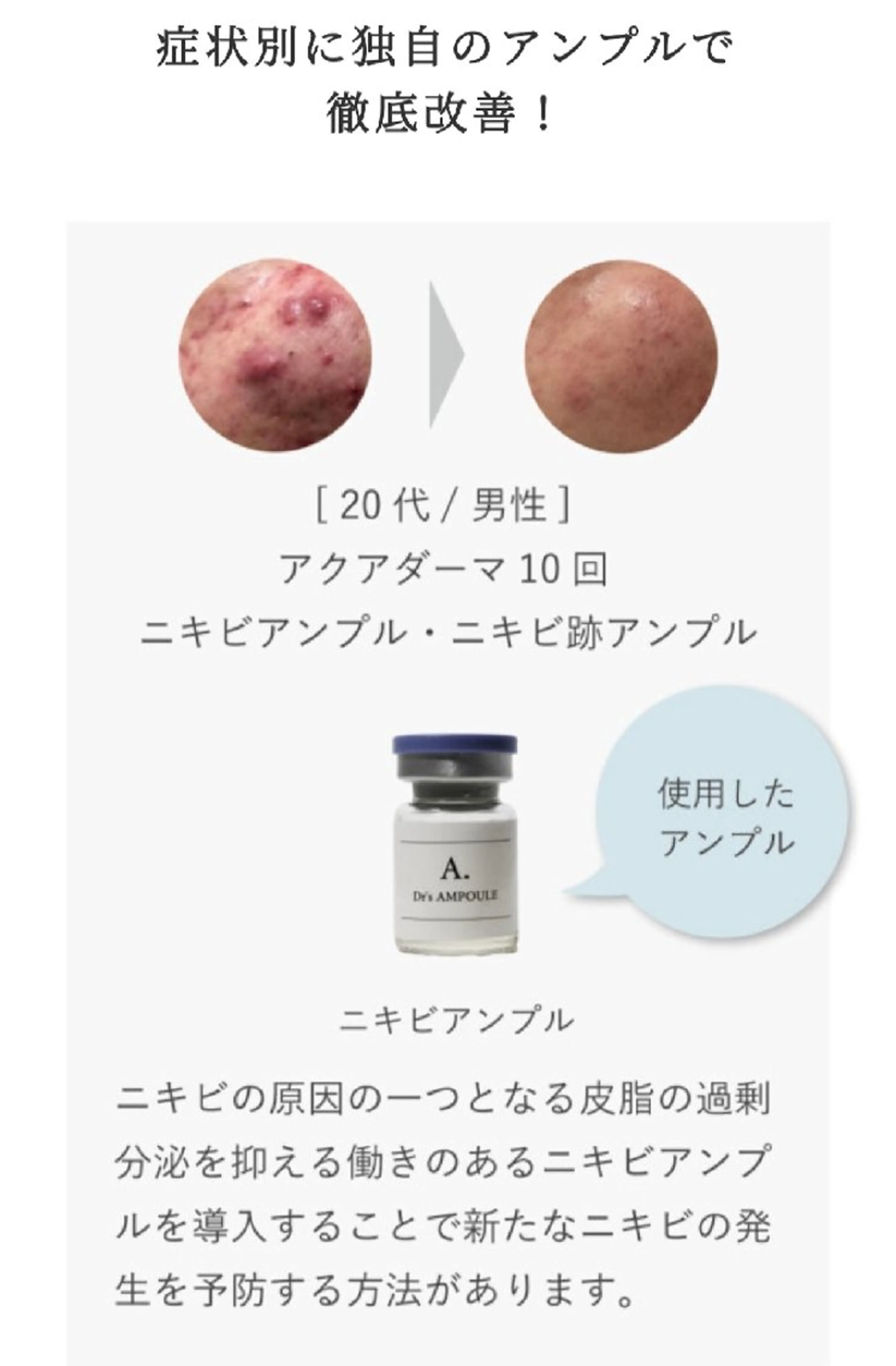 アクアダーマ（ニキビ跡アンプル）メニューの写真