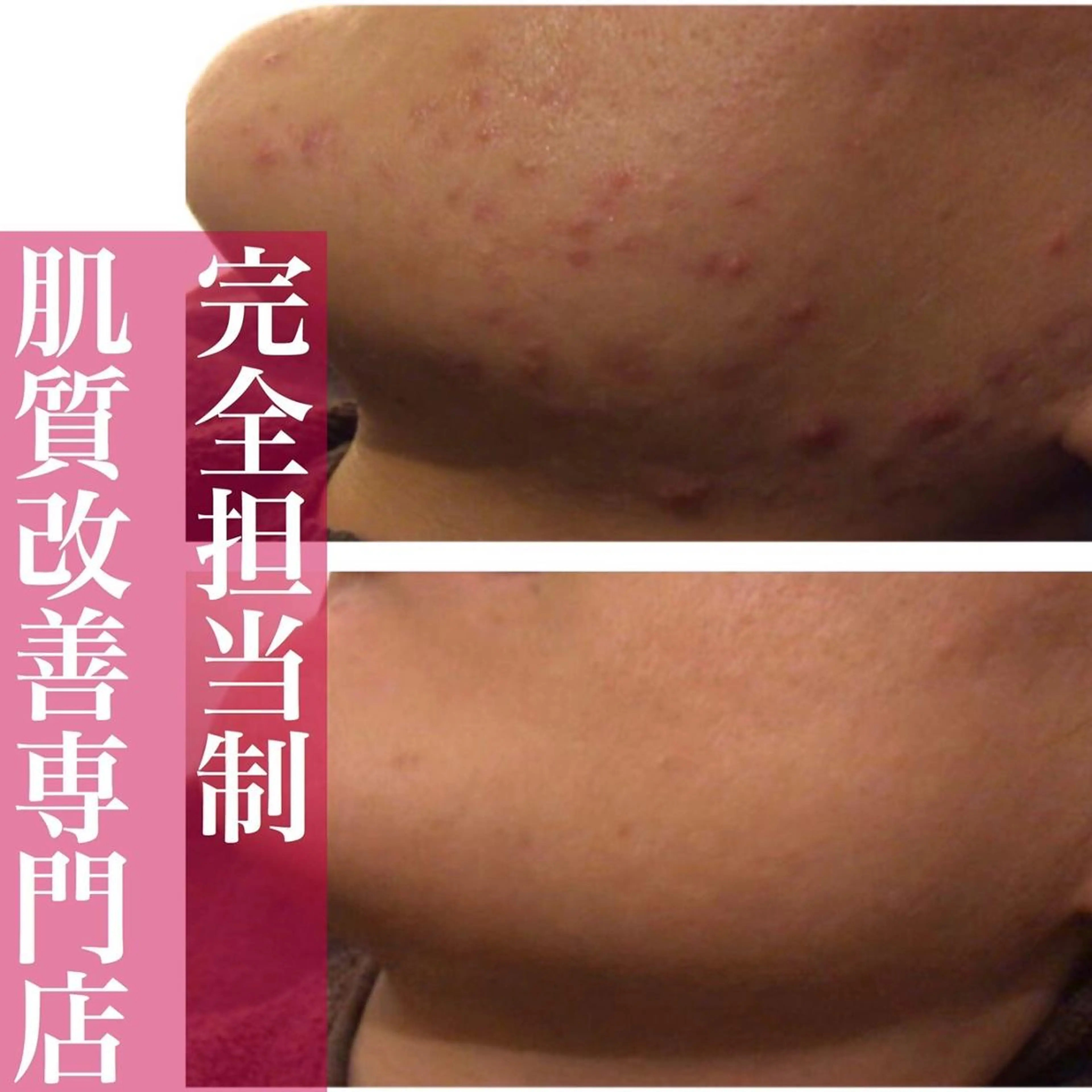 皮膚科より効果あり ⁉️最短ニキビ改善のエステ・リラクイメージ