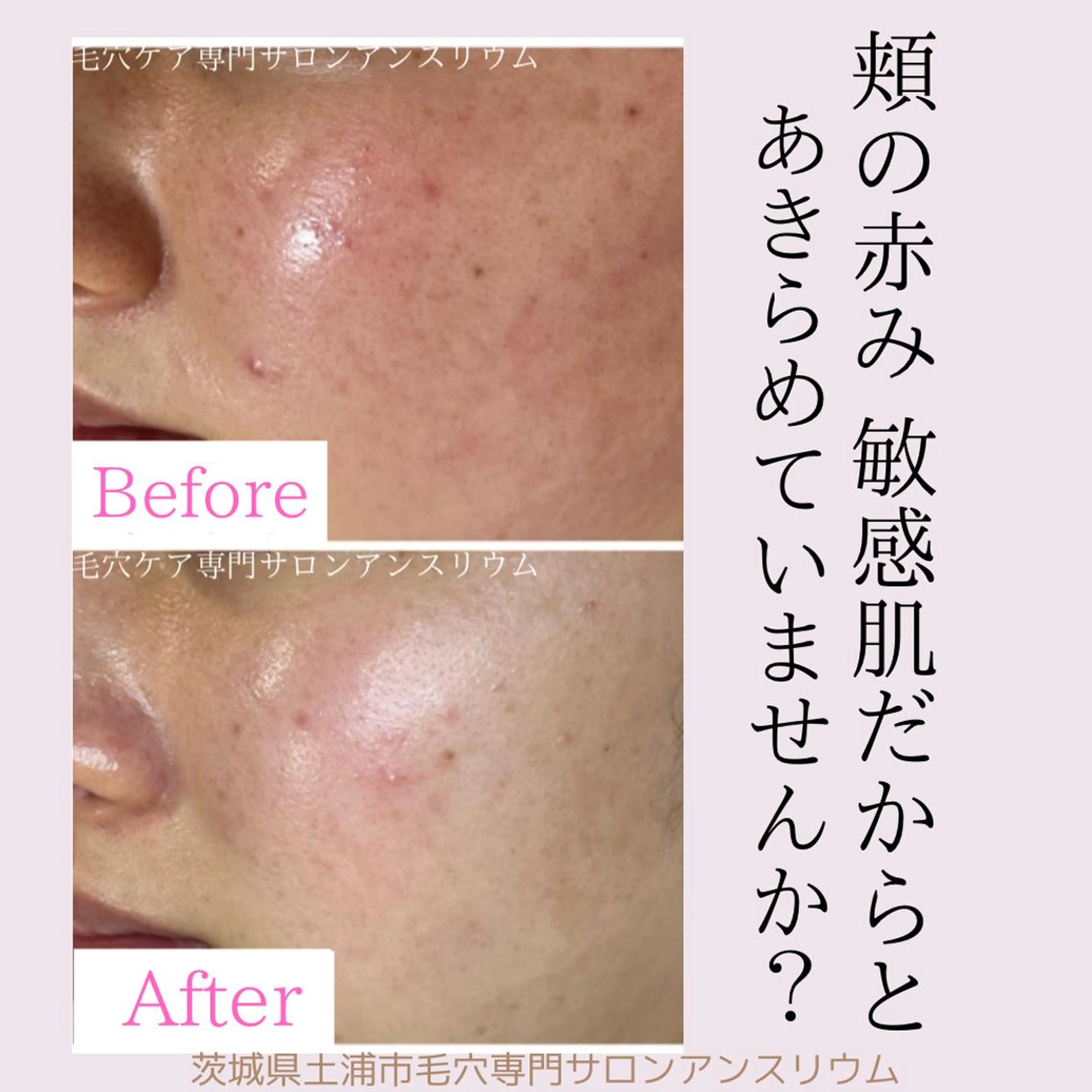 毛穴ケア専門サロンアンスリウム所属・茨城土浦 つくば毛穴 ケア専門サロンのエステ・リラクイメージ
